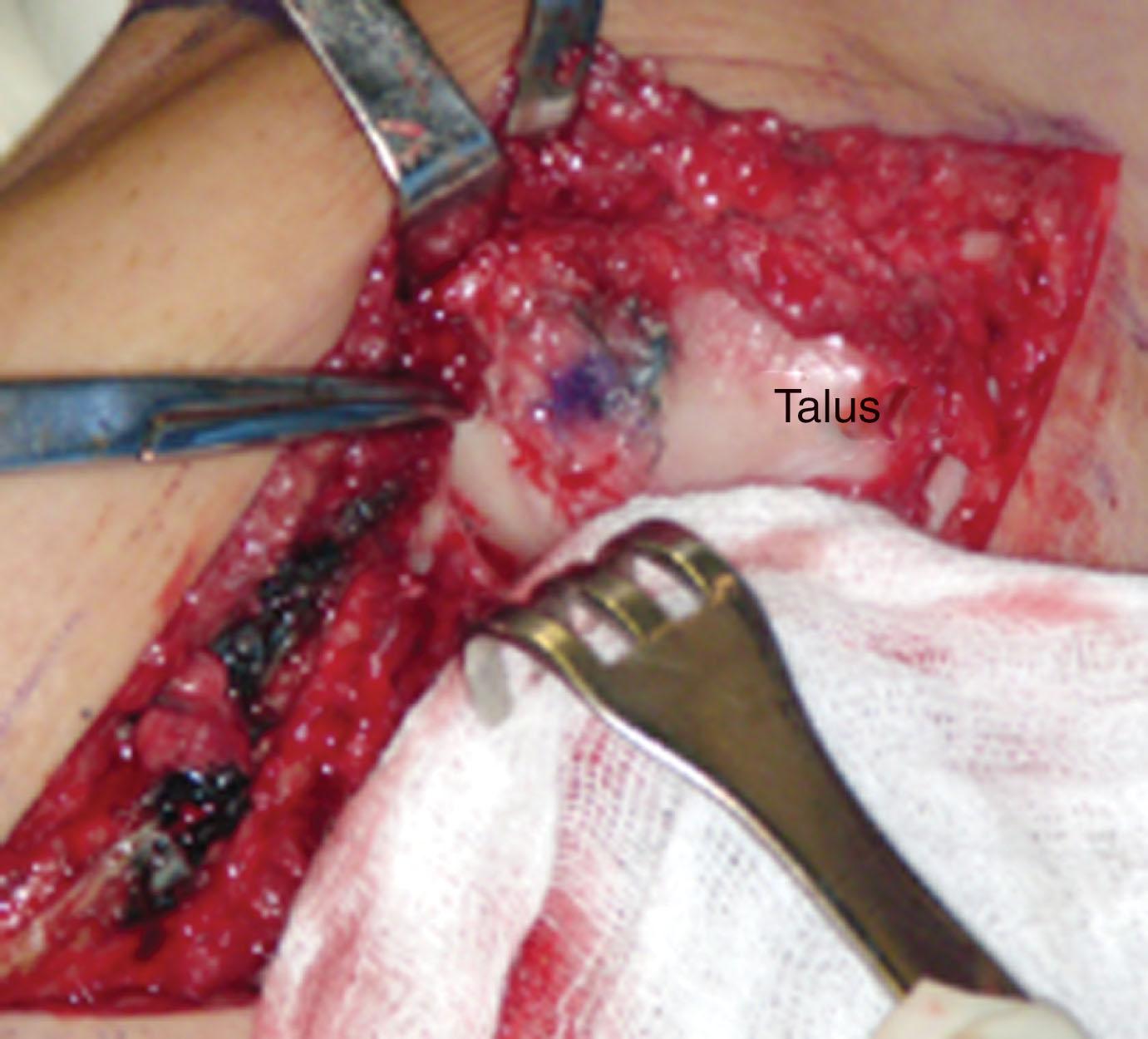 Fig. 40-21, Autologous chondrocyte implantation (ACI) was performed for this anterolateral osteochondral lesion of the talus. Note the periosteal covering sutured in place. The osteotomized distal fibula is retracted by the inferior retractor.