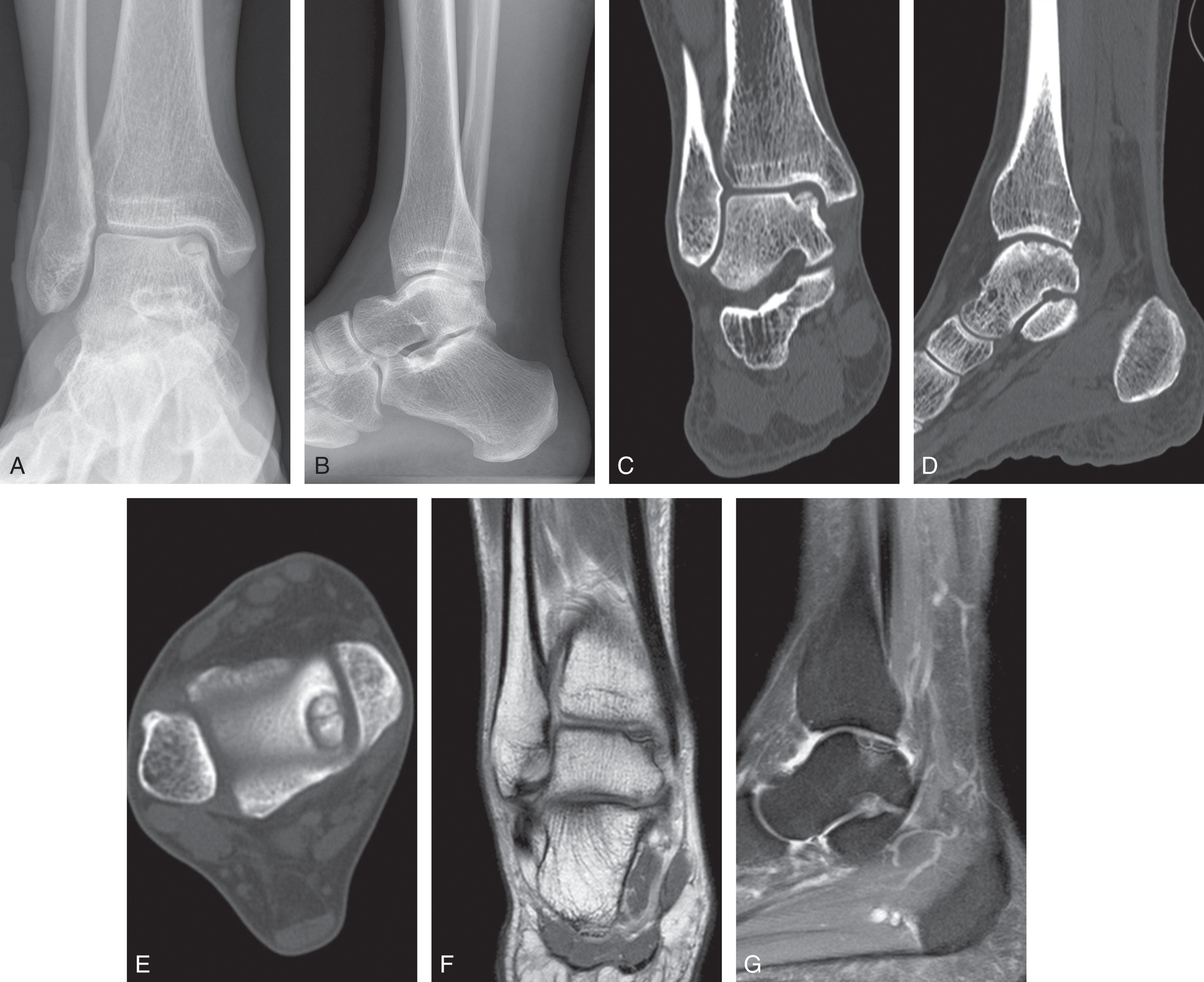 Fig. 40-3, Imaging of a type III osteochondral lesion of the medial talar dome. A and B , Anteroposterior and lateral radiograph. C to E , Coronal, sagittal, and axial CT scan cuts. F and G , coronal T1 and sagittal T2 MRI views.