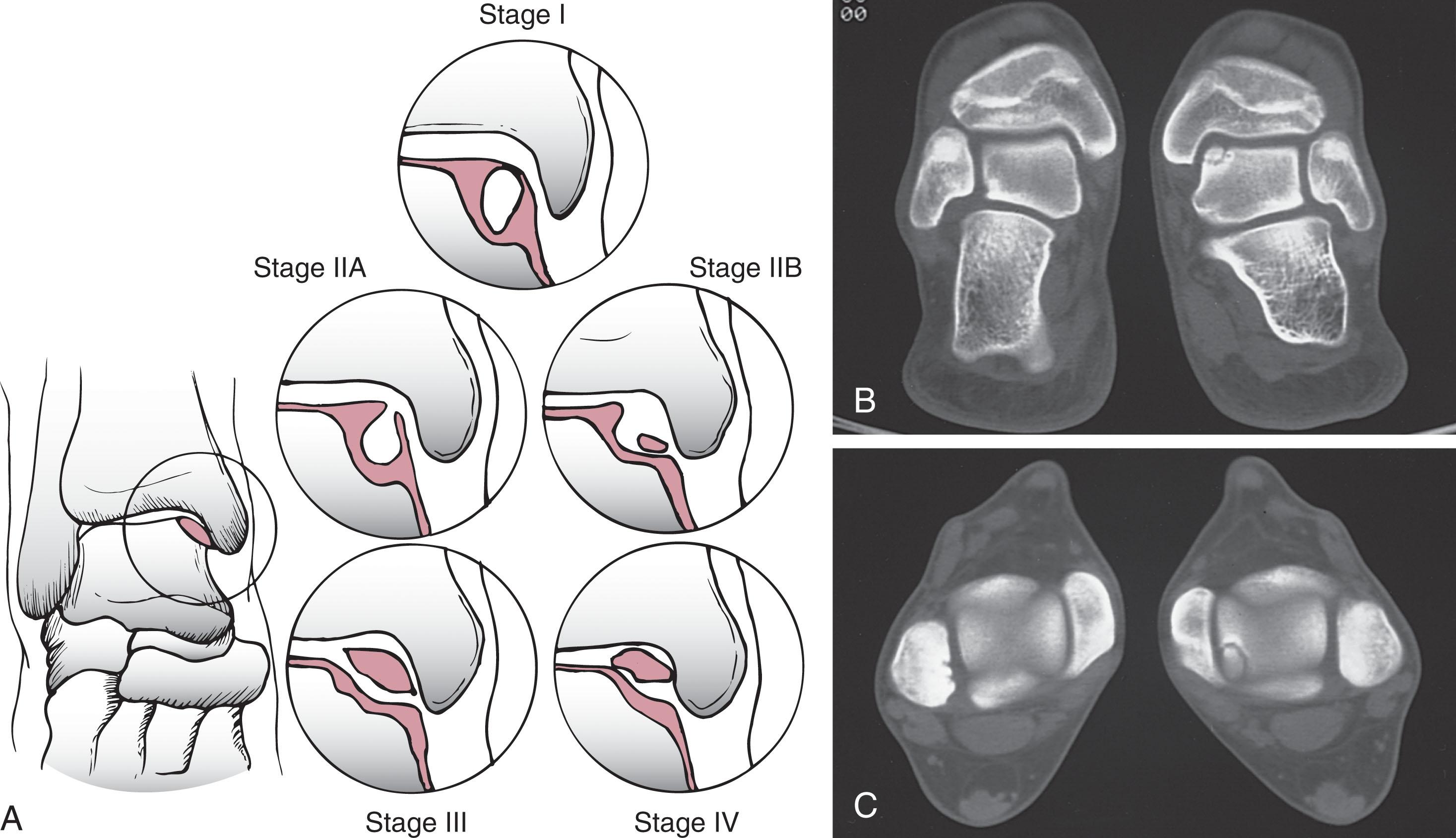 Fig. 40-4, Schematic of Ferkel & Sgaglione computed tomography (CT) staging for osteochondral lesions of the talus.