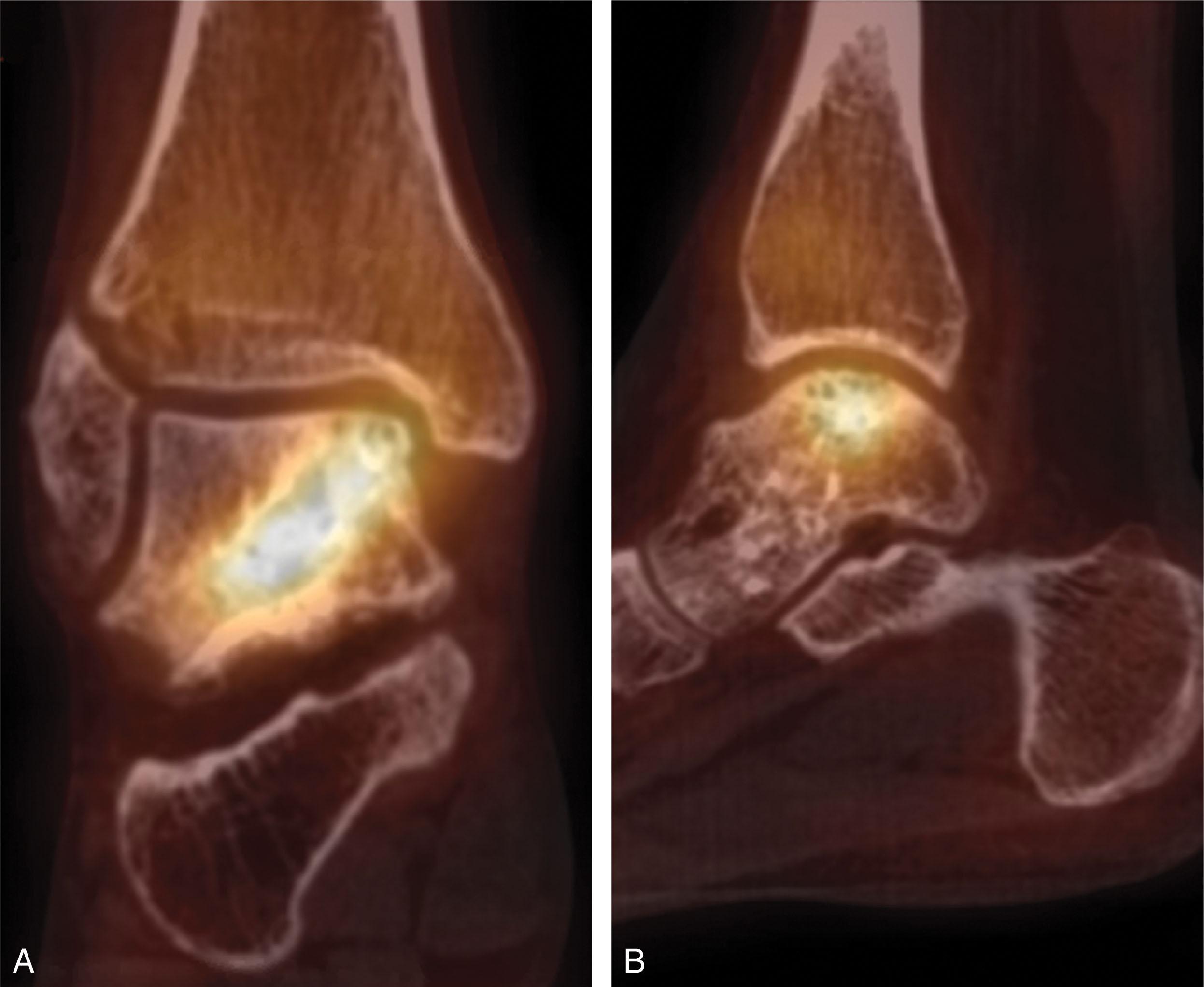 Fig. 40-5, Single photon emission computed tomography (SPECT-CT) images showing 99m Tc-labeled phosphonate uptake superimposed over a CT scan image in a patient that had prior retrograde drilling of a medial talar dome osteochondral lesion. A , coronal view and B , sagittal view.