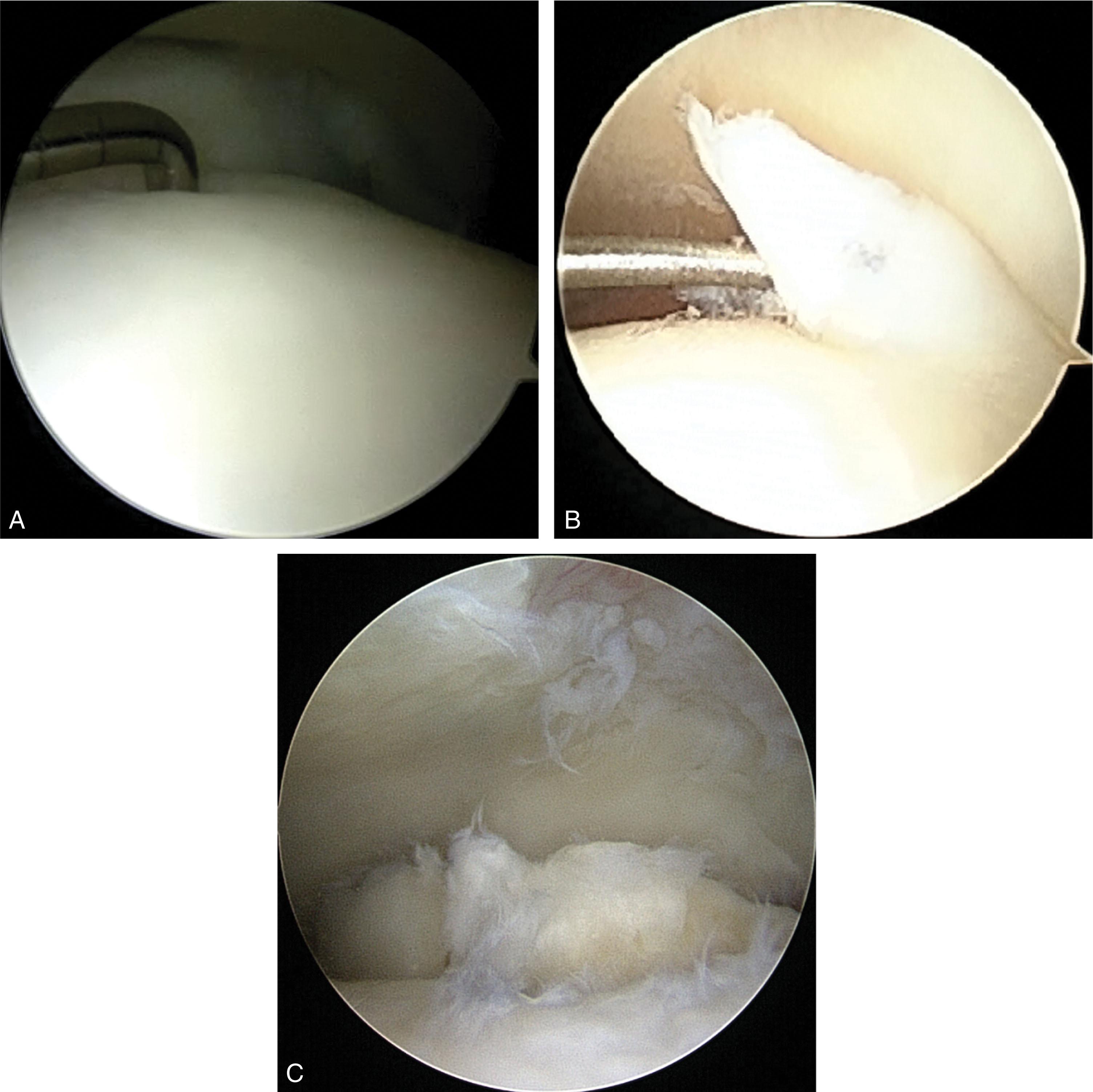 Fig. 40-6, Arthroscopic views of osteochondral lesions of the talus (OLTs). A , View from the anteromedial portal of a central-lateral Ferkel Grade A/ICRS Grade OCD-I OLT. B , View from the anterolateral portal of a posteromedial Grade D/OCD-II OLT. C , View from the anterolateral portal of a central-medial Grade F/OCD-IV OLT.