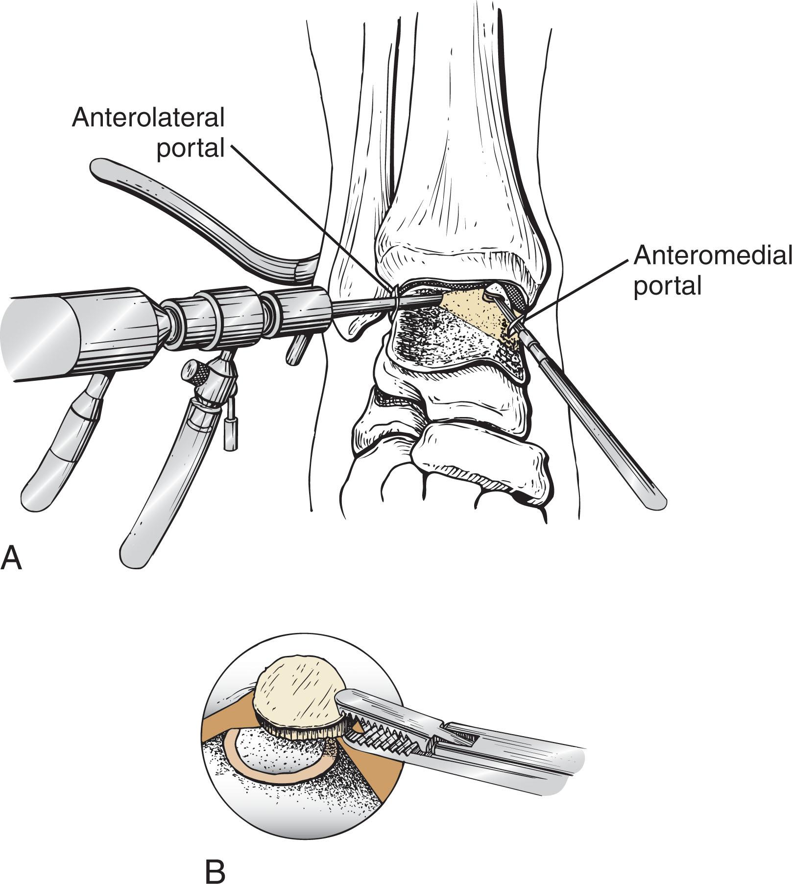 Fig. 40-9, Excision of osteochondral lesions of the talus. Inflow is through the posterolateral portal. A , Lesion is removed while visualizing through anterolateral portal and inserting a banana knife anteromedially. B , Once the lesion has been freed, it can be extracted with a grasper.