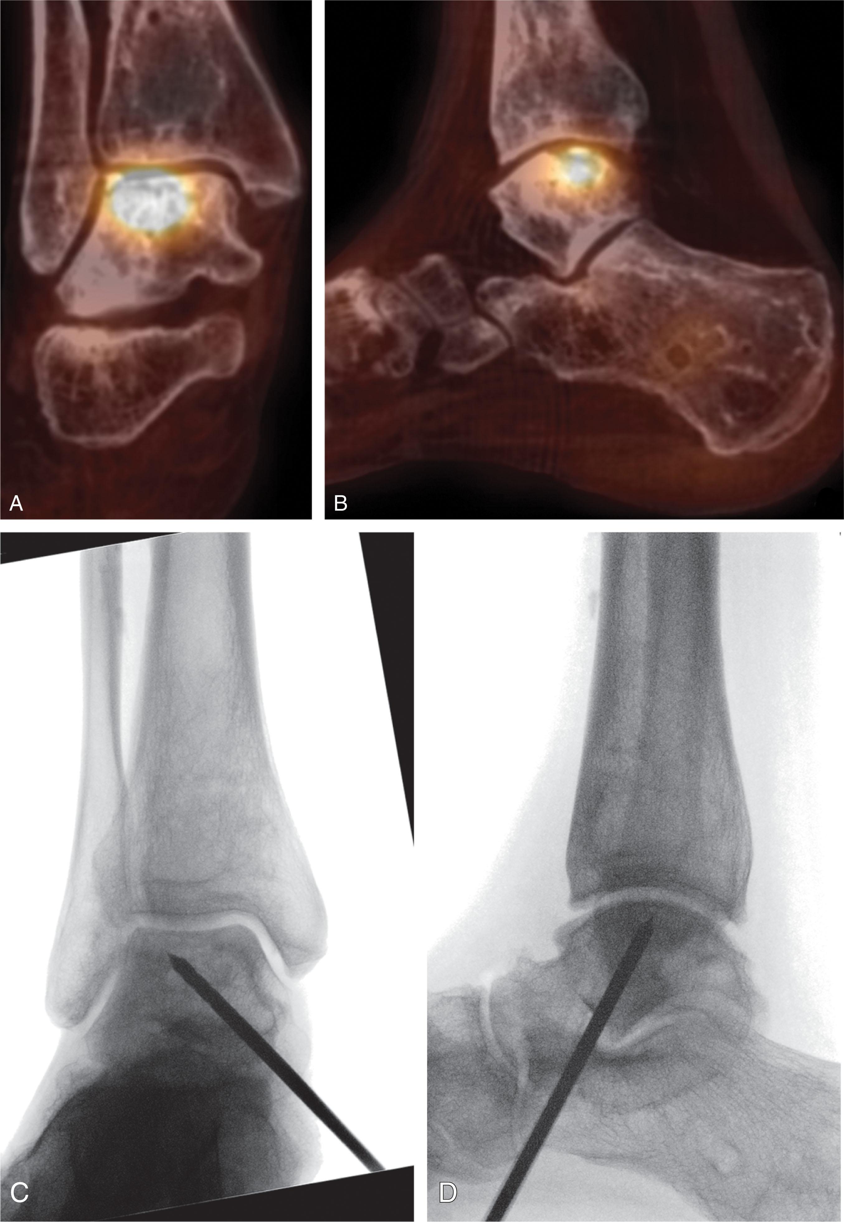 Fig. 40-10, A and B , Single positron emission computed tomography (SPECT- CT) views in a patient with avascular necrosis. The central-medial talar dome shows increased metabolic activity consistent with the patient’s pain. C and D , Intraoperative fluoroscopy is used to place a pin in a retrograde fashion from the sinus tarsi into the area of the talar dome identified on preoperative imaging. Concentrated bone marrow aspirate is then injected.