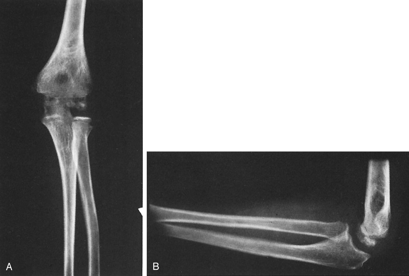 FIG 33.1, (A) Anteroposterior view of the right elbow of a 9-year-old boy shows involvement of the entire capitellum in alternating irregular areas of sclerosis and patchy rarefaction. (B) The lateral view shows osteochondrosis.