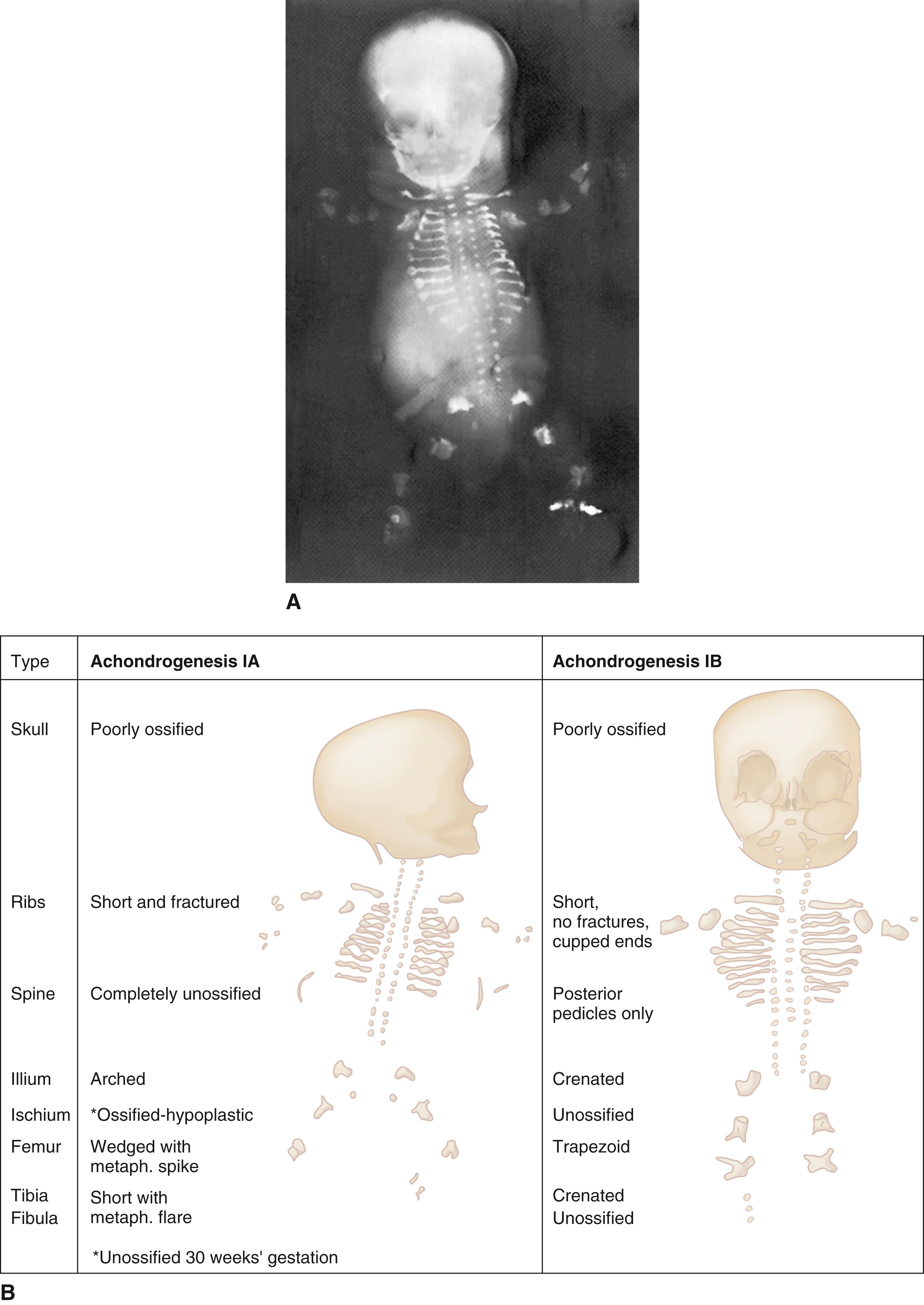 FIGURE 1, A, Stillborn infant at 30 weeks’ gestation with achondrogenesis type IA. B, Radiographic features that differentiate type IA from type IB are delineated on the drawings.