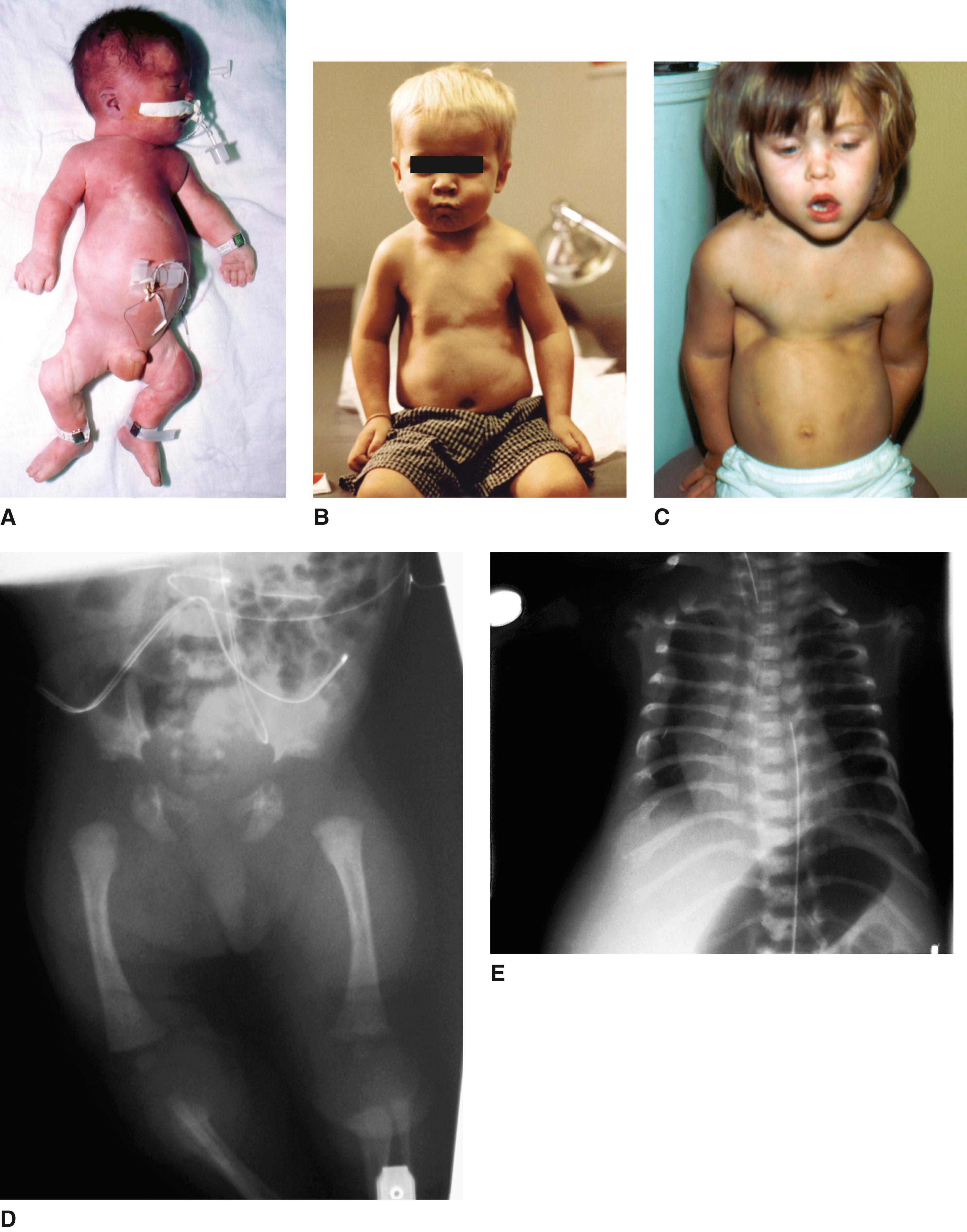 FIGURE 1, Jeune thoracic dystrophy.