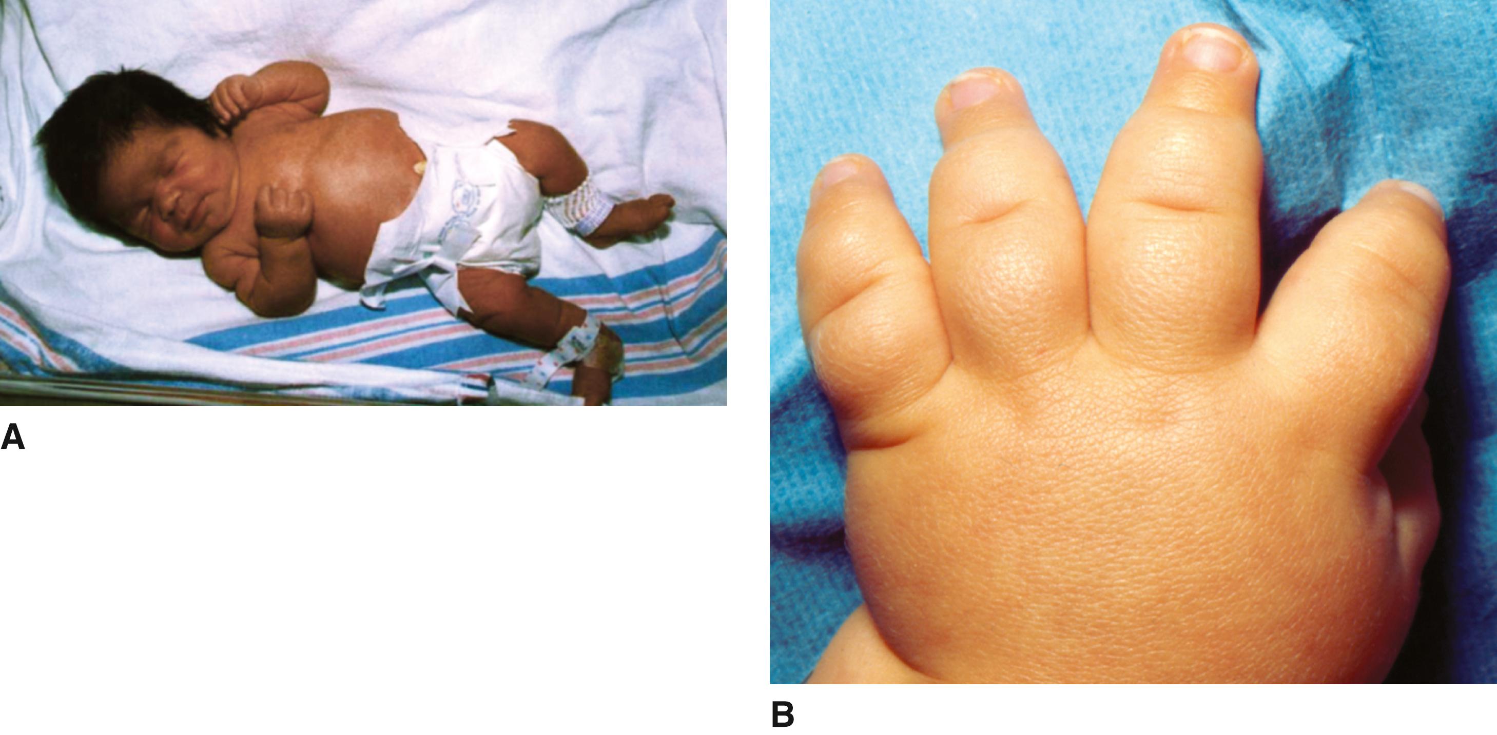 FIGURE 1, Achondroplasia.