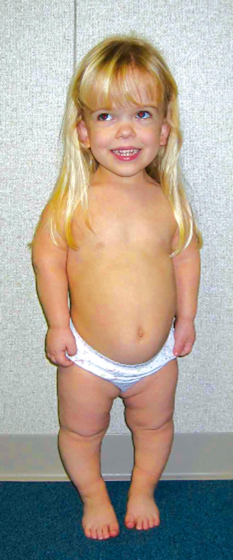 FIGURE 2, Photograph of a 1-year-old girl showing relative macrocephaly, small thoracic cage, and rhizomelic shortening.