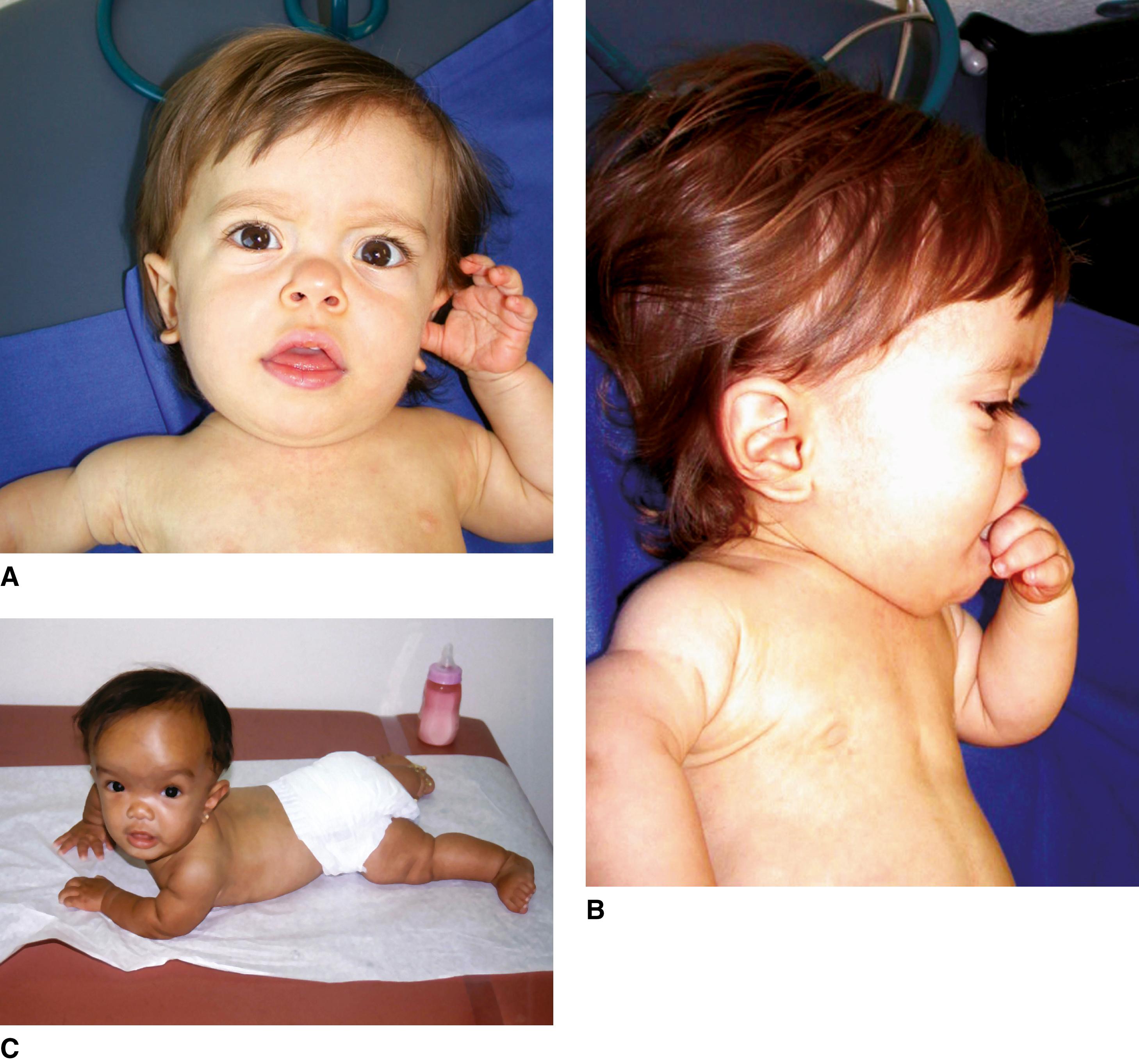 FIGURE 3, A–C, Two affected 6-month-old children. Note low nasal bridge, relative macrocephaly with prominent forehead, and midface hypoplasia.