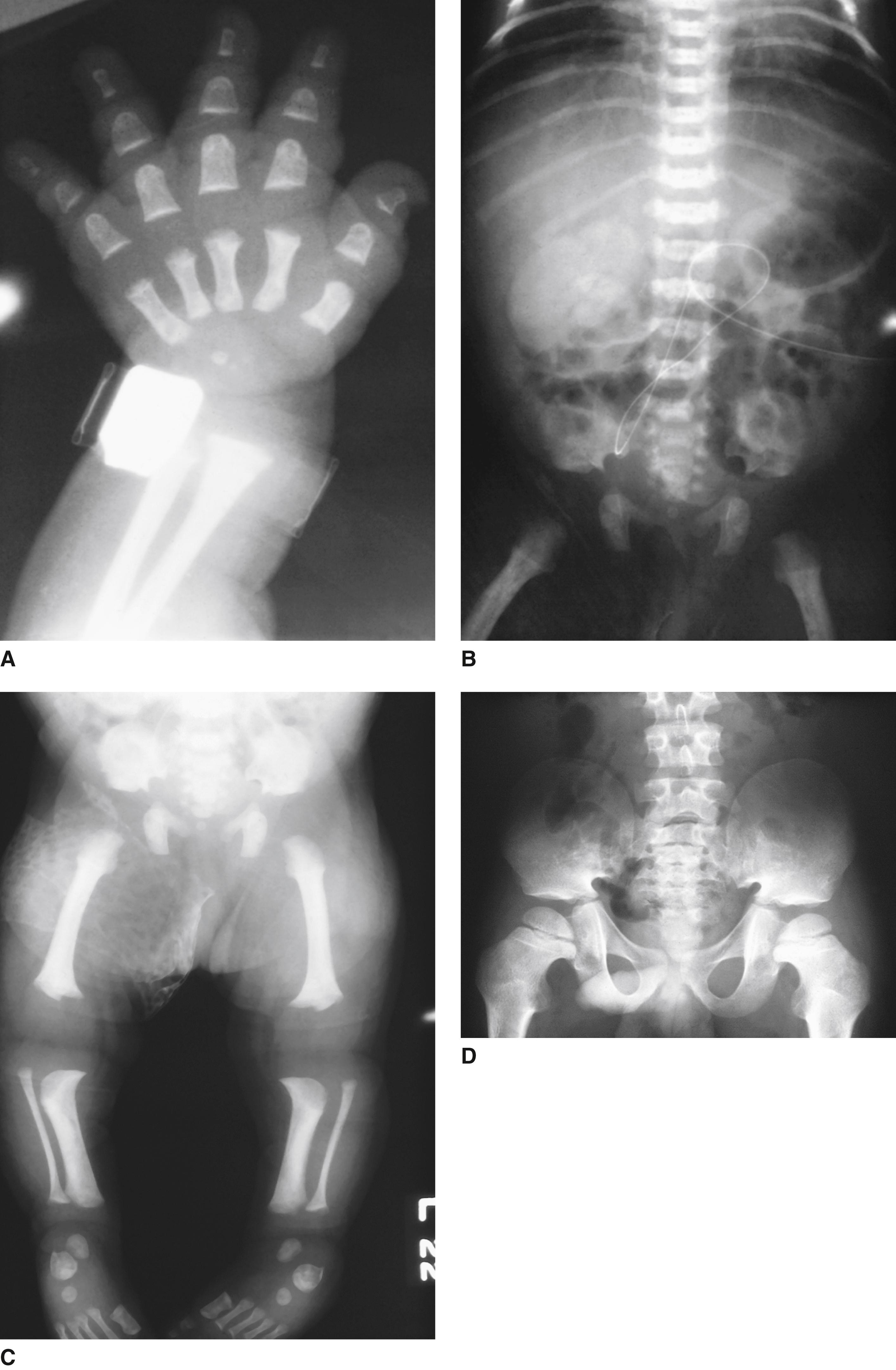 FIGURE 4, A and B, Note in the newborn period, the “trident” hand with short metacarpals and phalanges, caudal narrowing of spinal canal with short pedicles, and small iliac wings with narrow greater sciatic notch. C and D, Note the progressive changes in an older child and an adult.