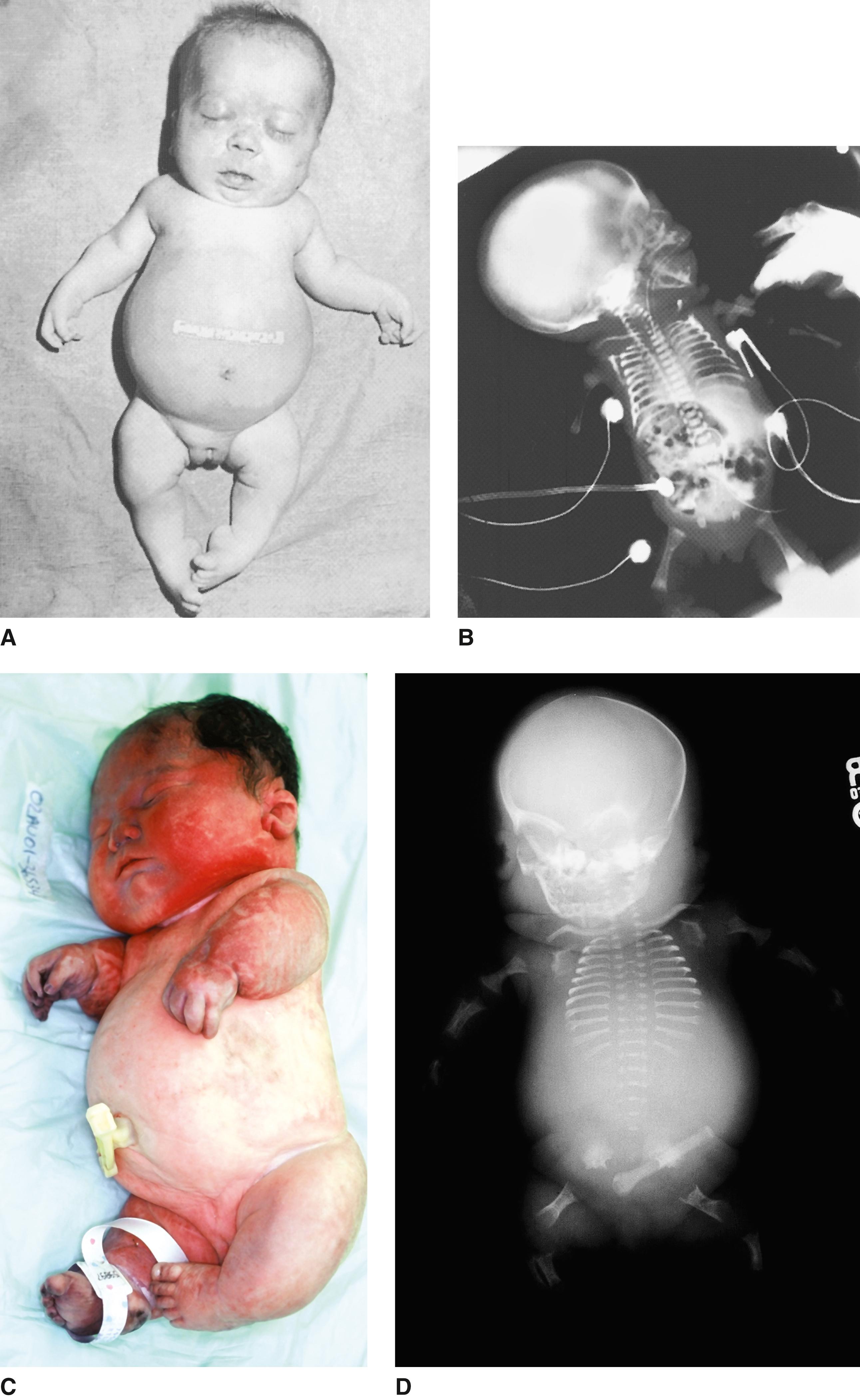 FIGURE 1, Two stillborn infants with type II achondrogenesis-hypochondrogenesis, showing the variation in severity of the disorder. Note the relatively normal cranial ossification, short ribs, and variable degrees of failure of ossification of lumbar and cervical spines, sacrum, and ischial and pubic bones.