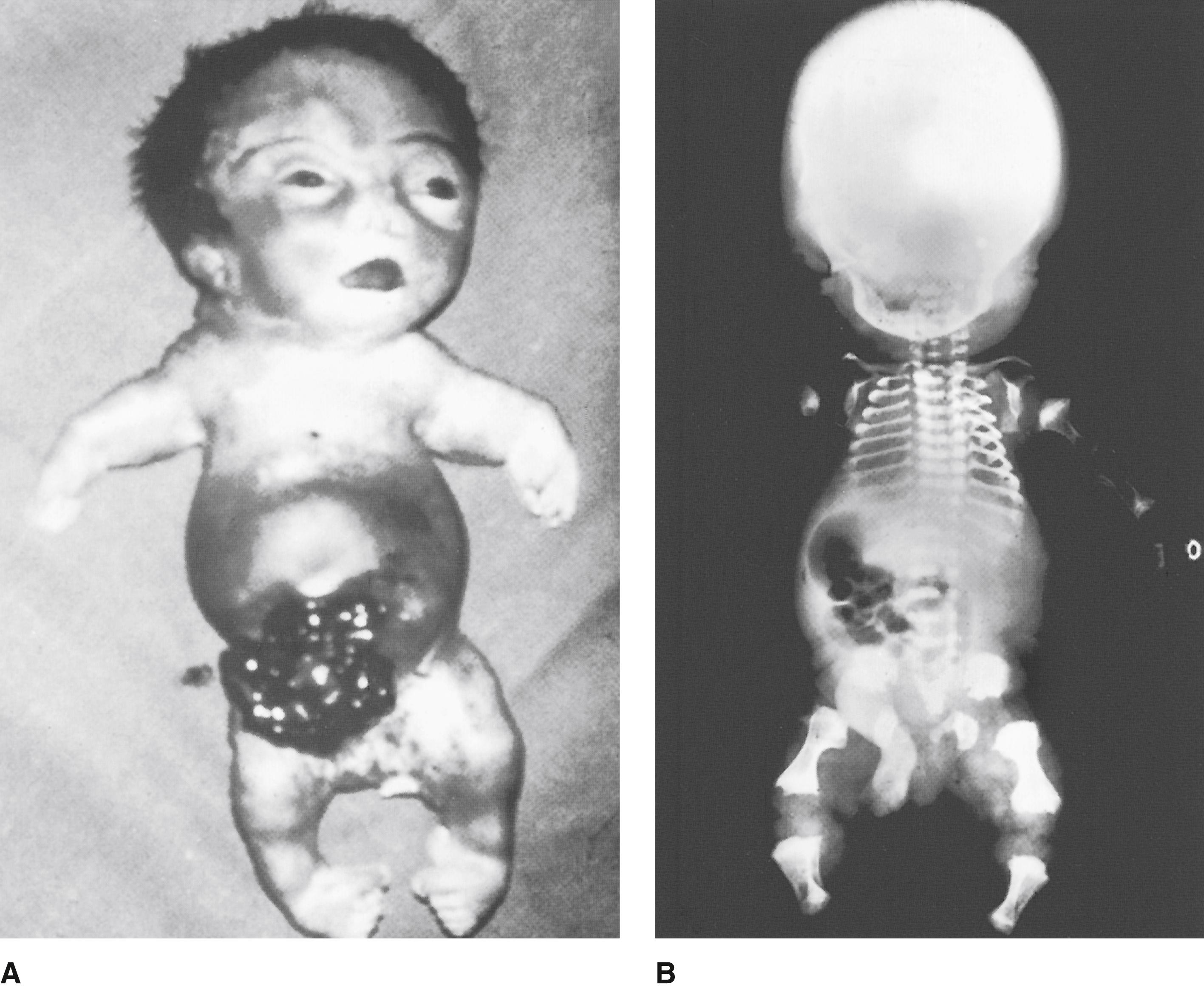 FIGURE 1, A, Stillborn infant with fibrochondrogenesis. Note the flat, wide nasal bridge, anteverted nares, short limbs, and equinovarus position of the feet. B, The radiograph reveals long, thin clavicles; short, thin ribs; flattened acetabula; narrow sacrosciatic notches; metaphyseal widening of the tibia and fibula; and dumbbell-shaped femora.