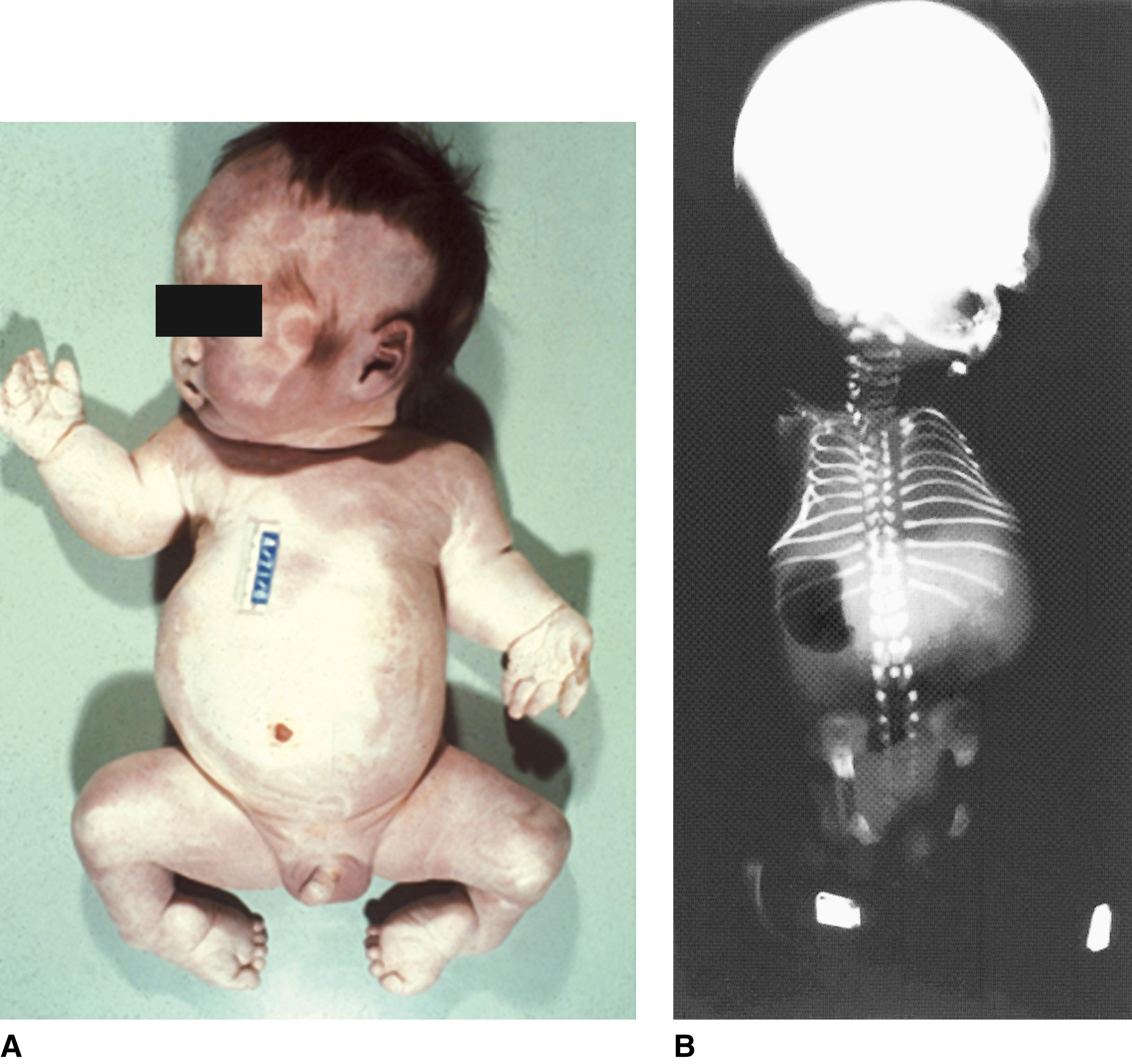 FIGURE 1, Atelosteogenesis type I.