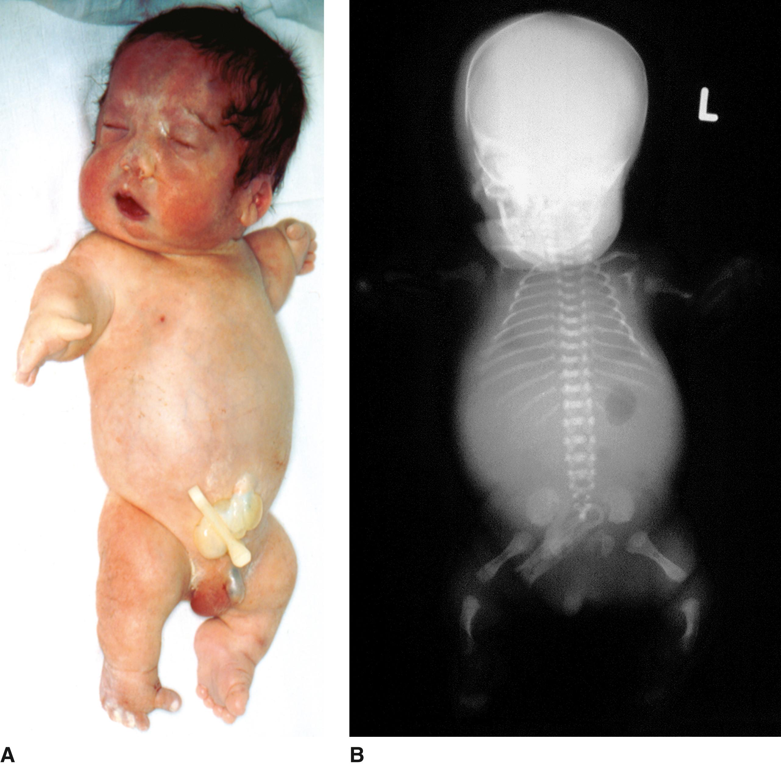 FIGURE 2, Atelosteogenesis type II.