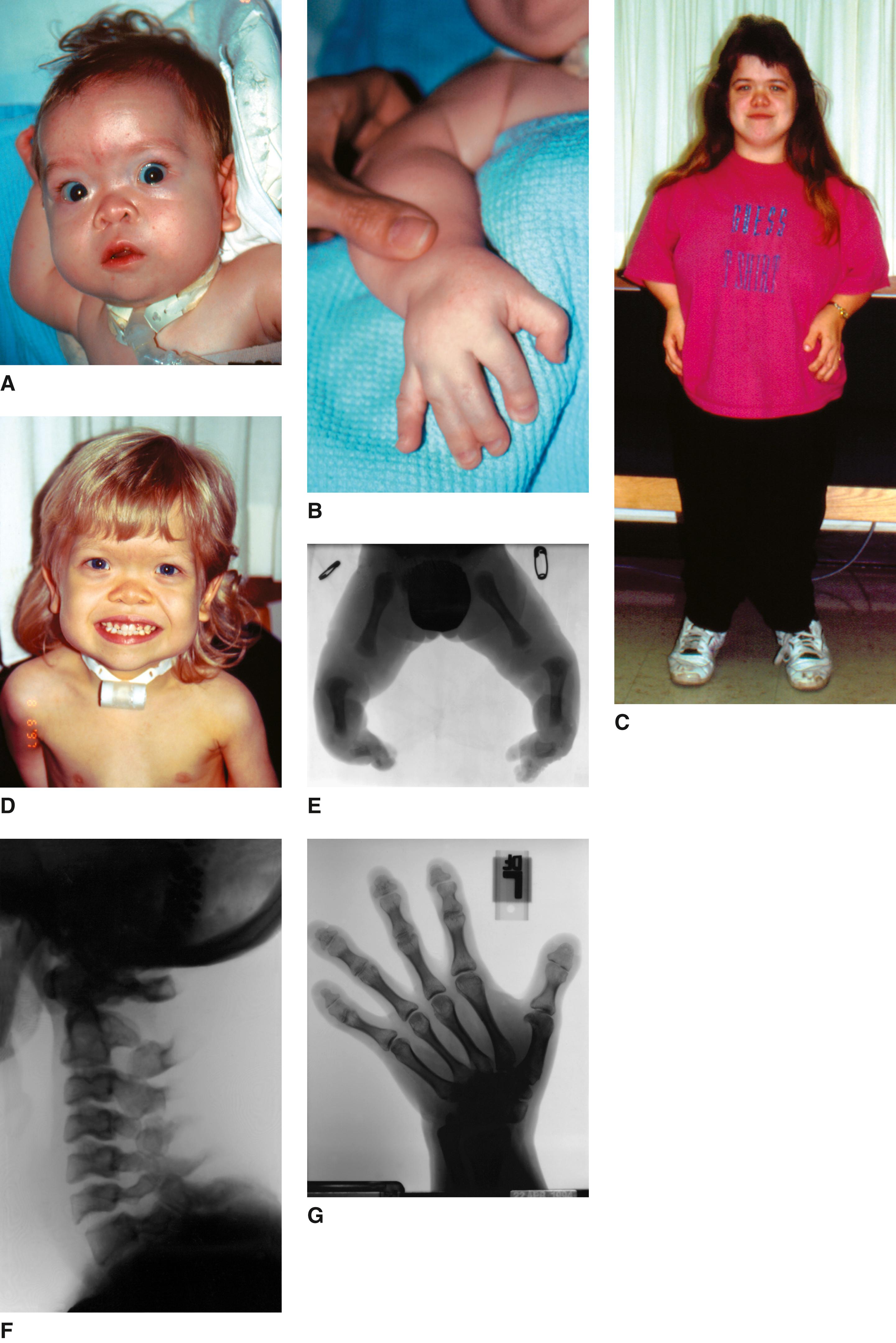 FIGURE 3, Atelosteogenesis type III.