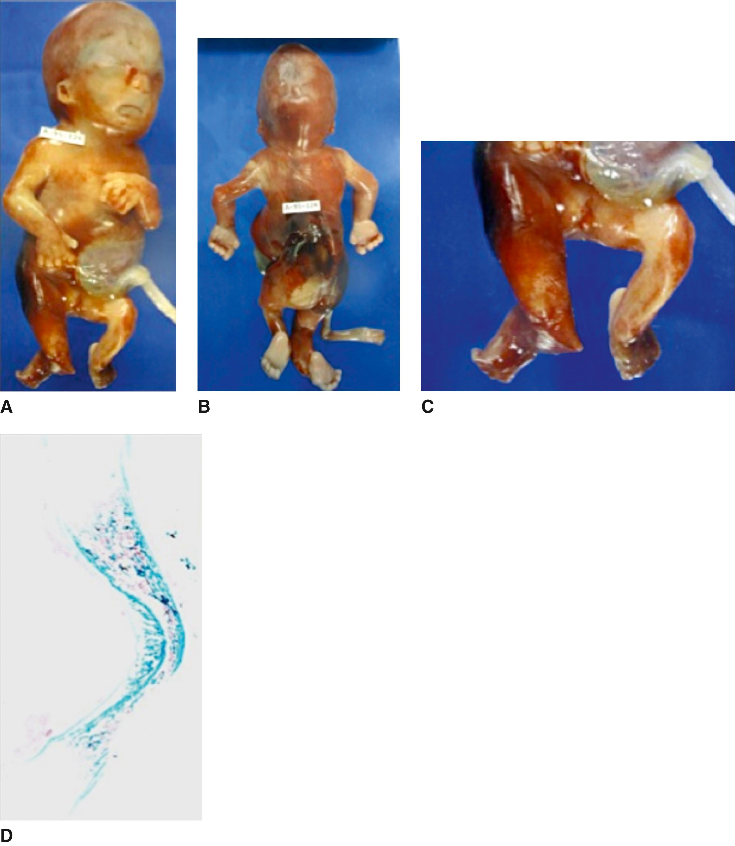 FIGURE 1, A fetus with boomerang dysplasia.