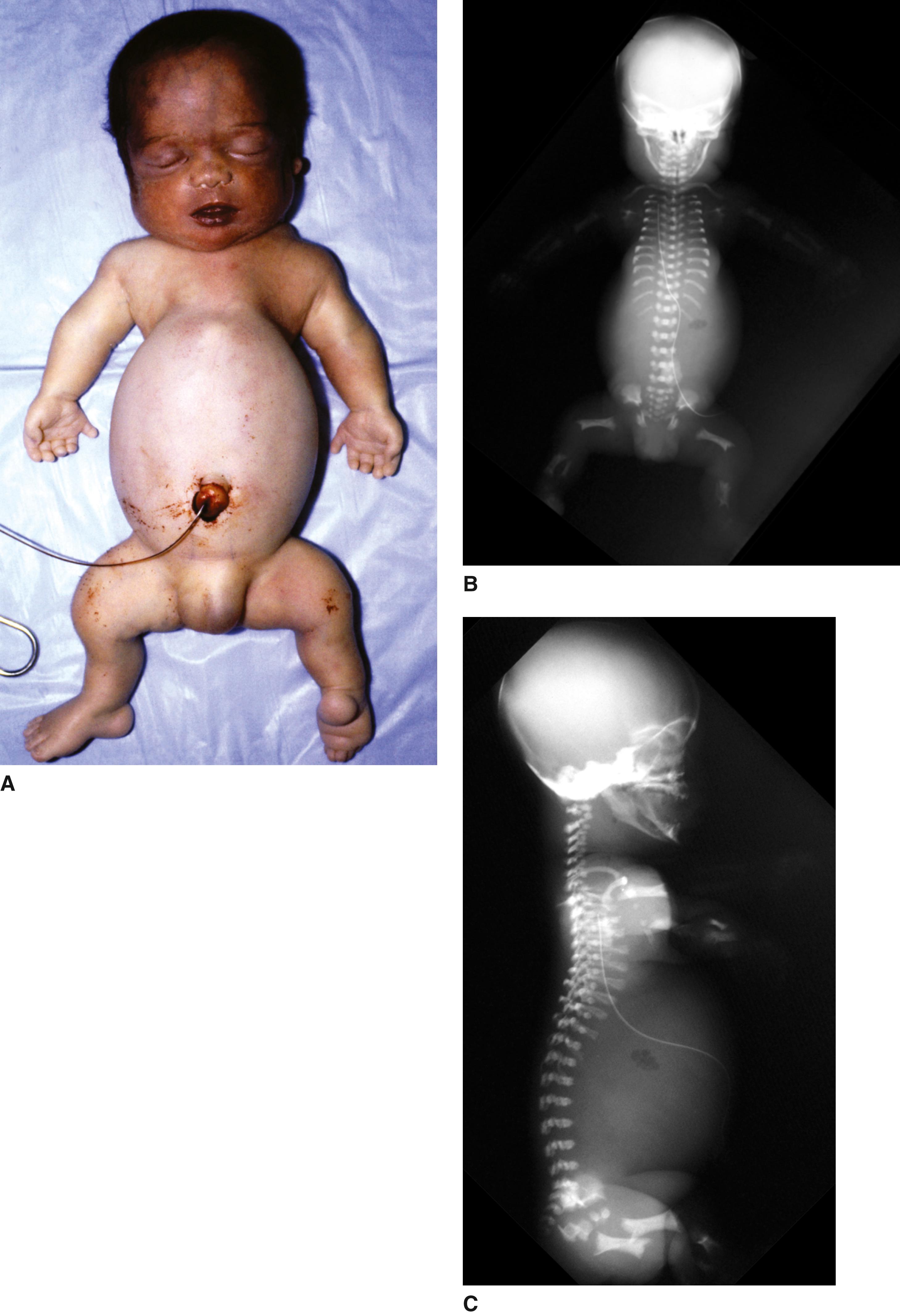 FIGURE 1, Short rib–polydactyly syndrome, Saldino-Noonan type.