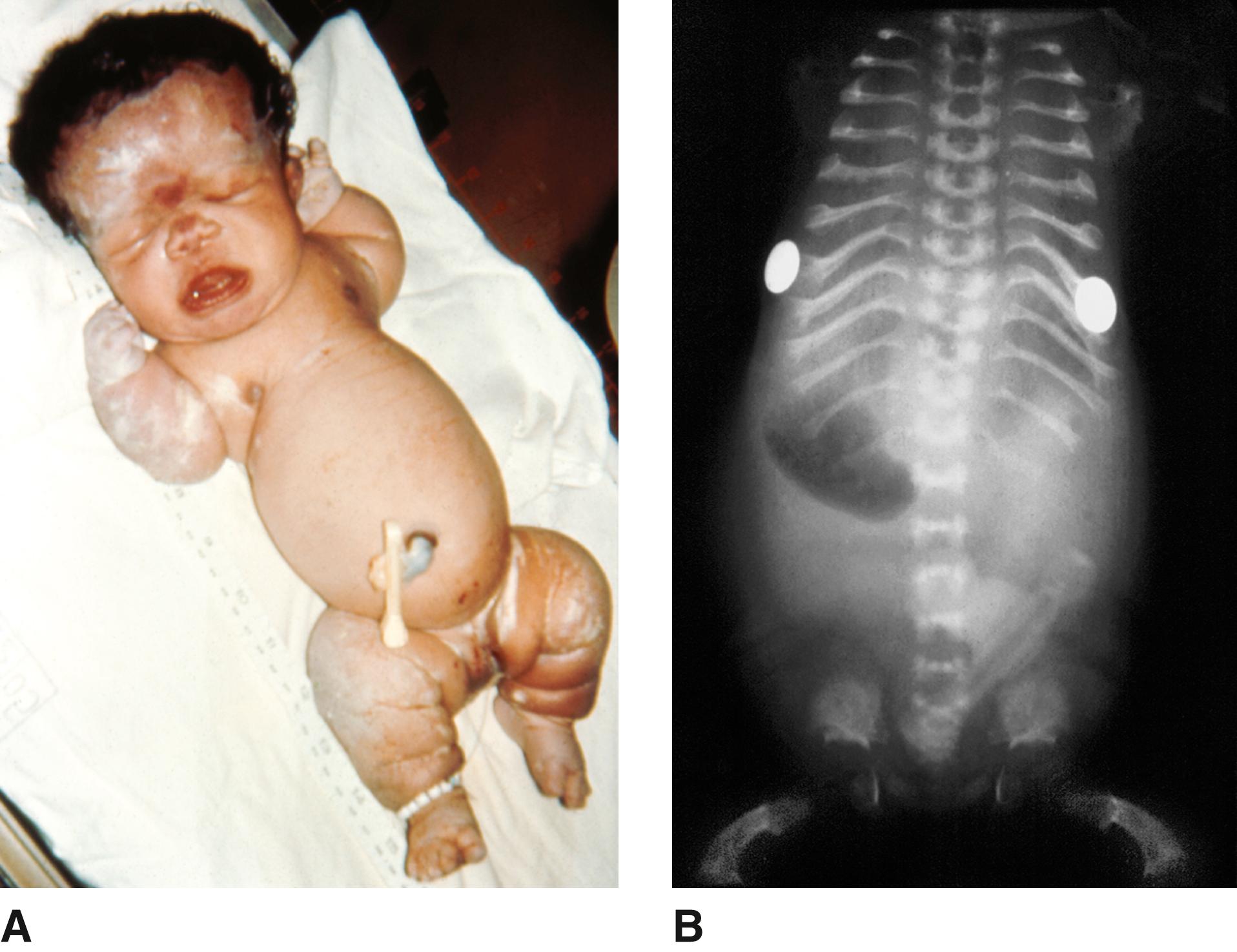 FIGURE 1, Thanatophoric dysplasia type I.