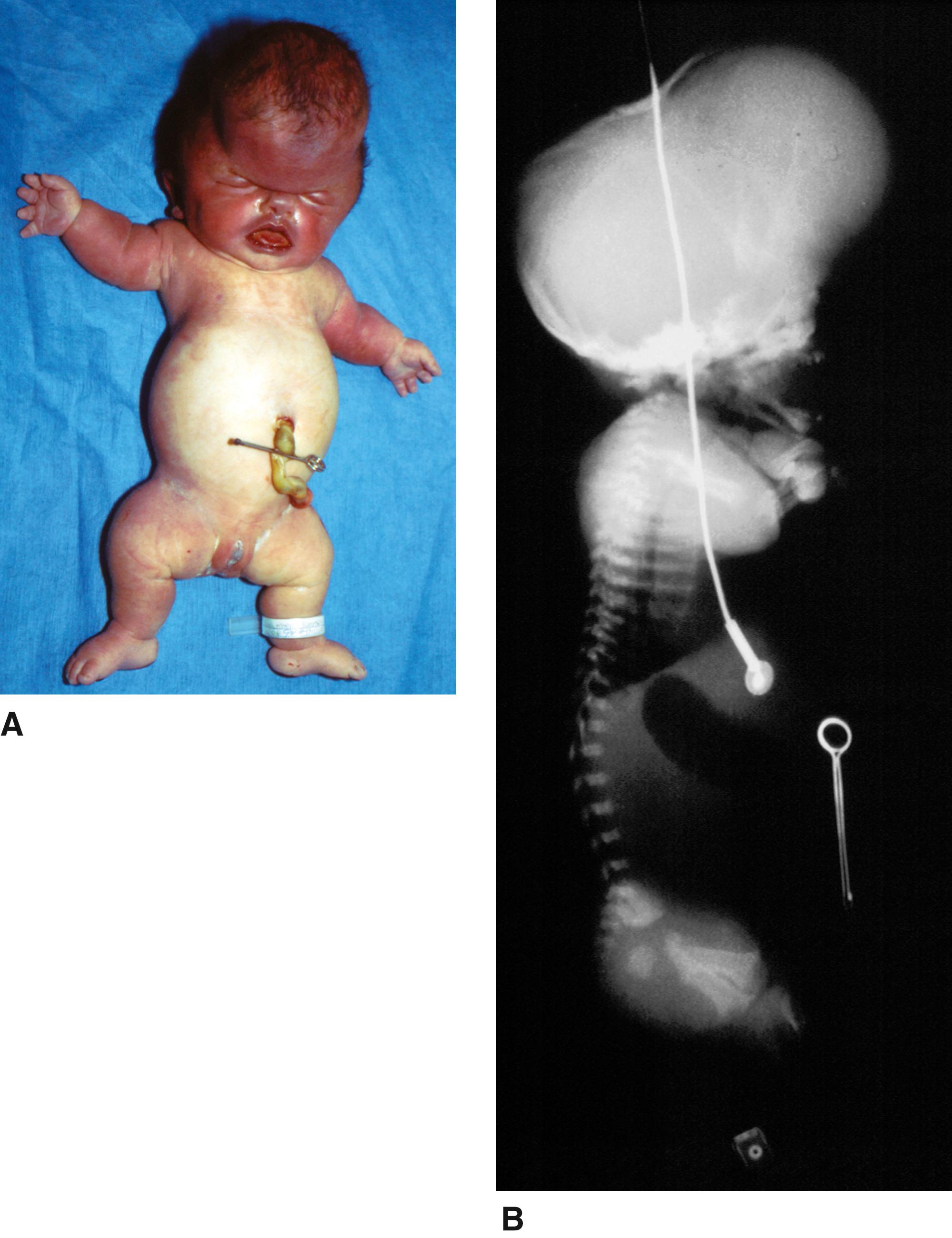 FIGURE 2, Thanatophoric dysplasia type II.