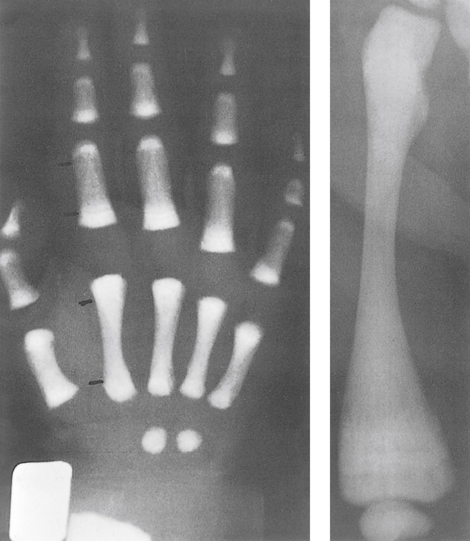 FIGURE 1, Osteopetrosis: autosomal recessive—lethal.