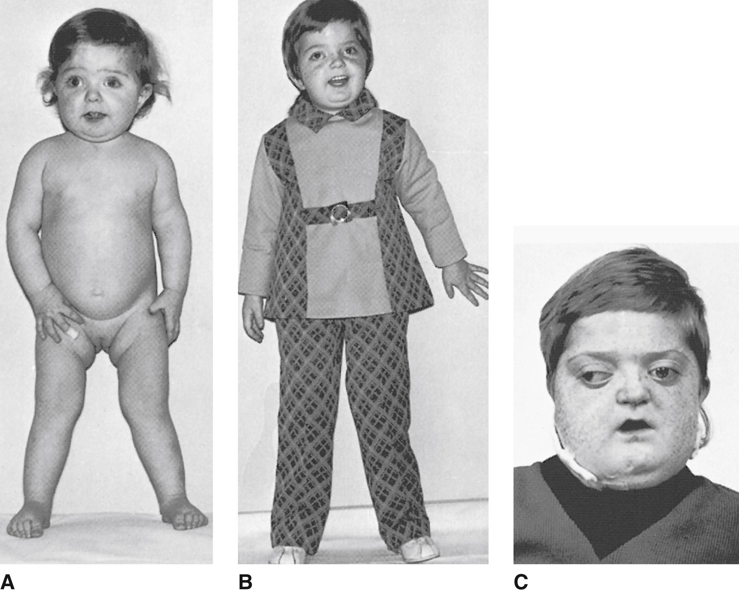 FIGURE 2, Same child at 2 years ( A ), with length at 3rd percentile and beginning genu valgum; at 3½ years ( B ), with vision lost, despite attempted decompression of optic nerve; and at 10½ years ( C ), with proptosis and mandibular osteitis. Her death at 11 years resulted from carotid artery compression.