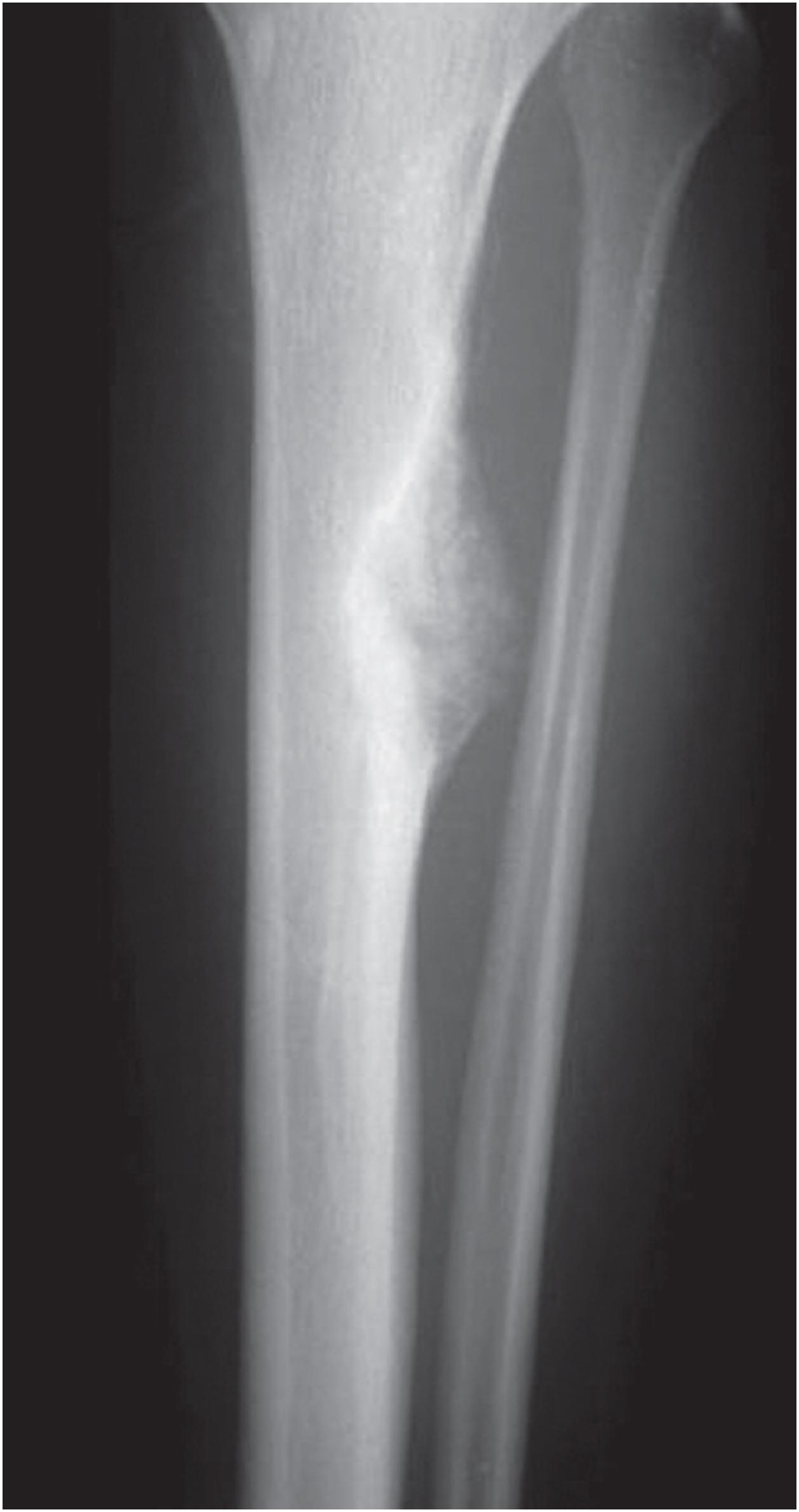 Fig. 22.1, Plain radiograph of OFD showing a lytic lesion within the tibial cortex with a sclerotic margin.