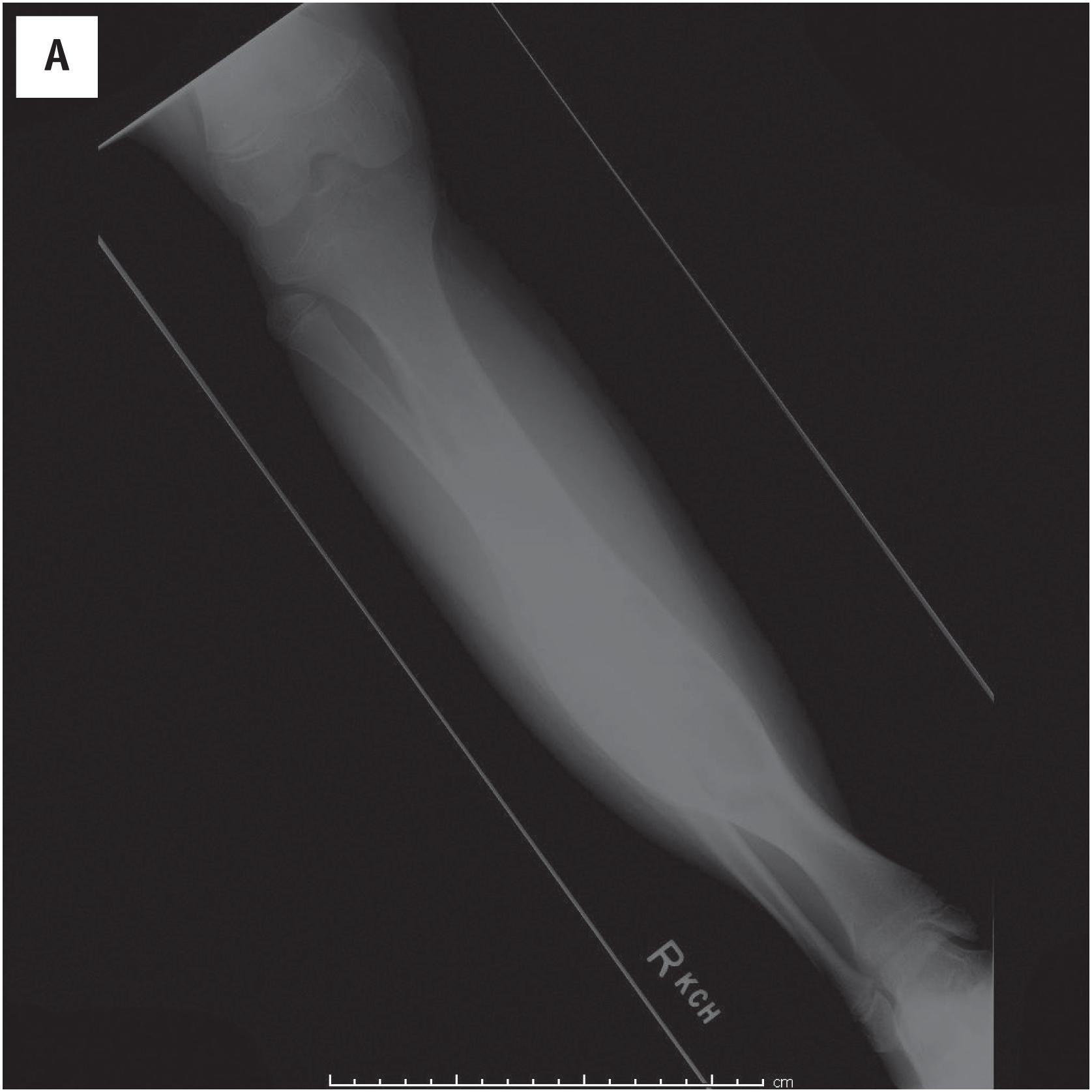 Fig. 22.2, Plain radiographs (A–B) and CT (C) scan of an OFD showing a large expansile mass involving the majority of the tibial diaphysis. There is significant anterior bowing of the tibia. The lesion is multiloculated and predominantly lytic with multiple osseous septations and a predominantly fibrous density to the lucent areas. There is definite cortical thinning anteriorly with relative thickening of the cortex posteriorly. There is a pathologic fracture involving the distal tibia laterally. (D) Gross examination of the resection specimen demonstrates white-tan tumor with cystic changes. Note the anterior bowing and osseous septations.