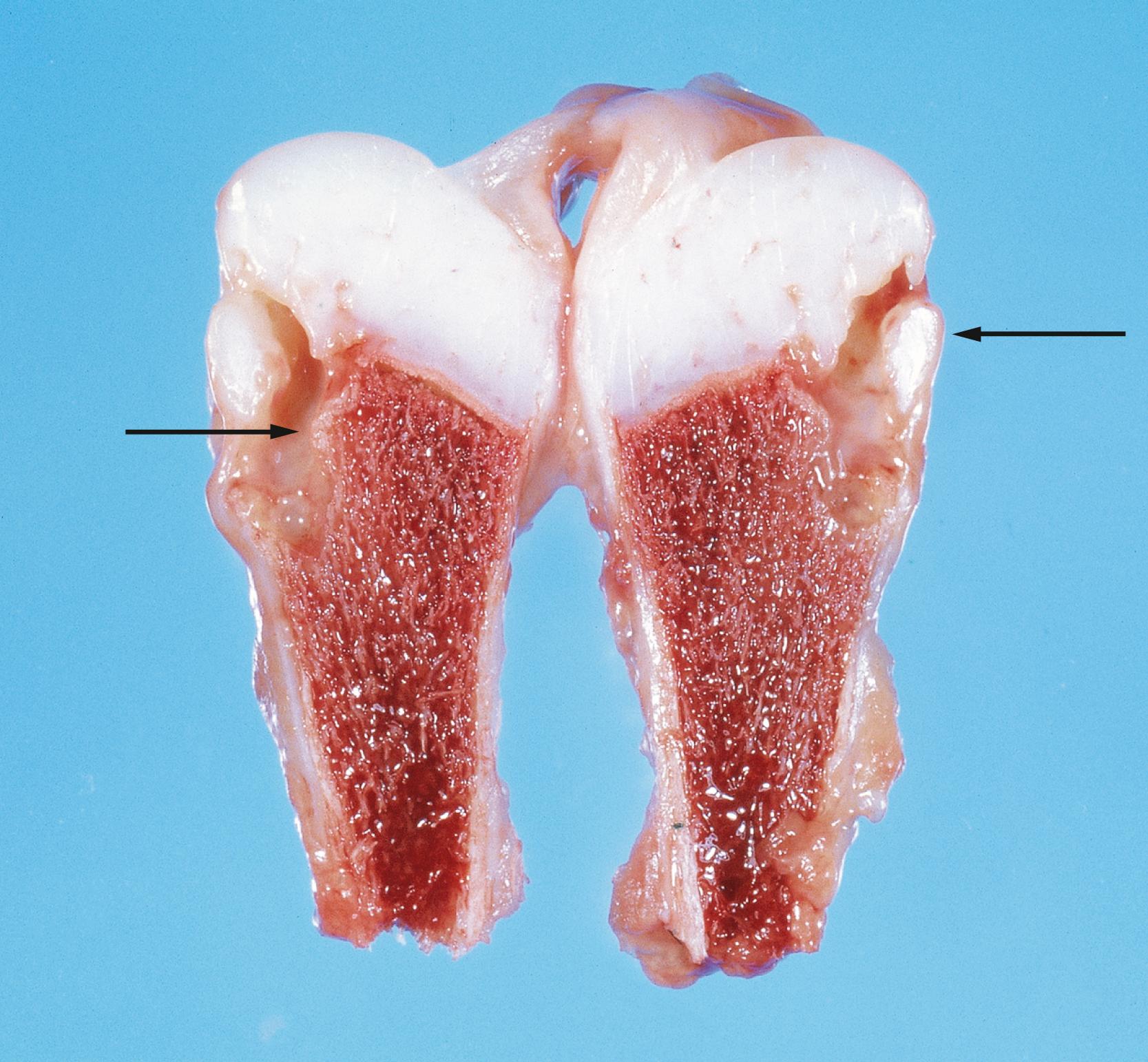 FIGURE 75.1, Gross specimen shows osteomyelitis of the proximal humerus in a 6-week-old infant. Note the metaphyseal location and bony destruction ( arrows ).