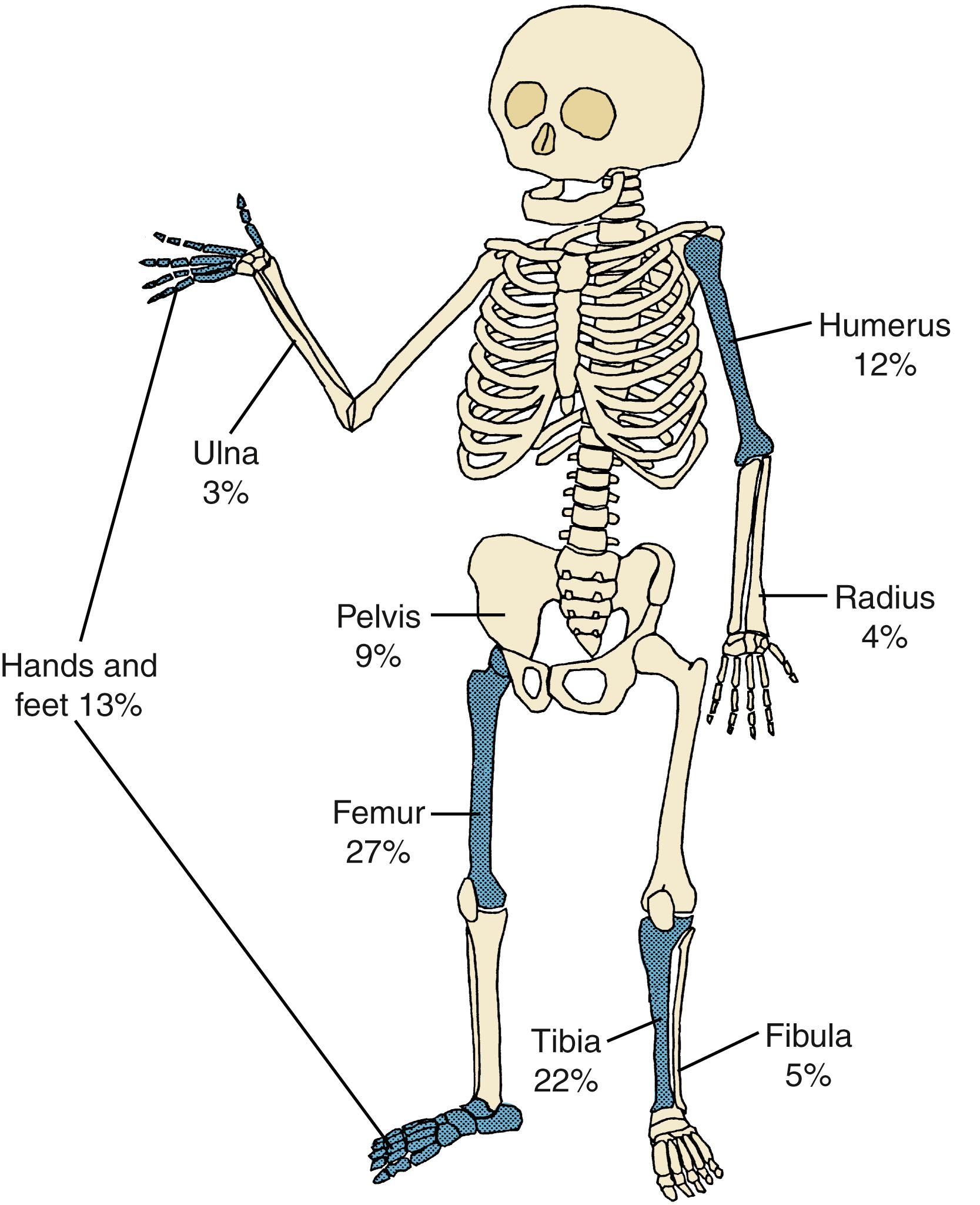 FIGURE 75.3, Sites of acute osteomyelitis in 657 children in whom a single bone was involved. Shaded areas constitute sites of approximately 75% of cases. Miscellaneous sites accounting for 5% are not shown.