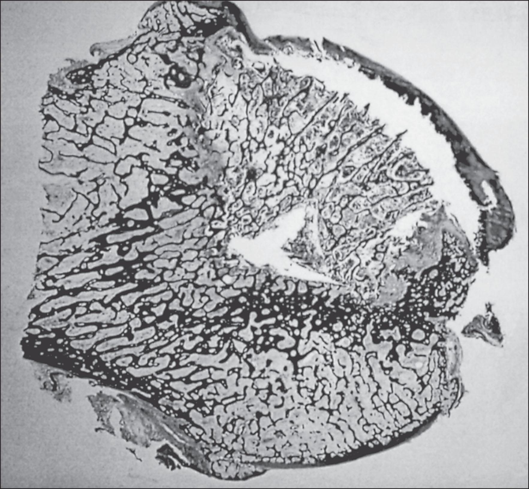 Fig. 208.1, Coronal section of a femoral head removed during total hip replacement. The cartilage above the sequestrum is of irregular height. Osteophytes of the superior and inferior aspects of the femoral head are present. There is a sclerotic border delineating the sequestrum. The trabecular architecture is otherwise preserved.