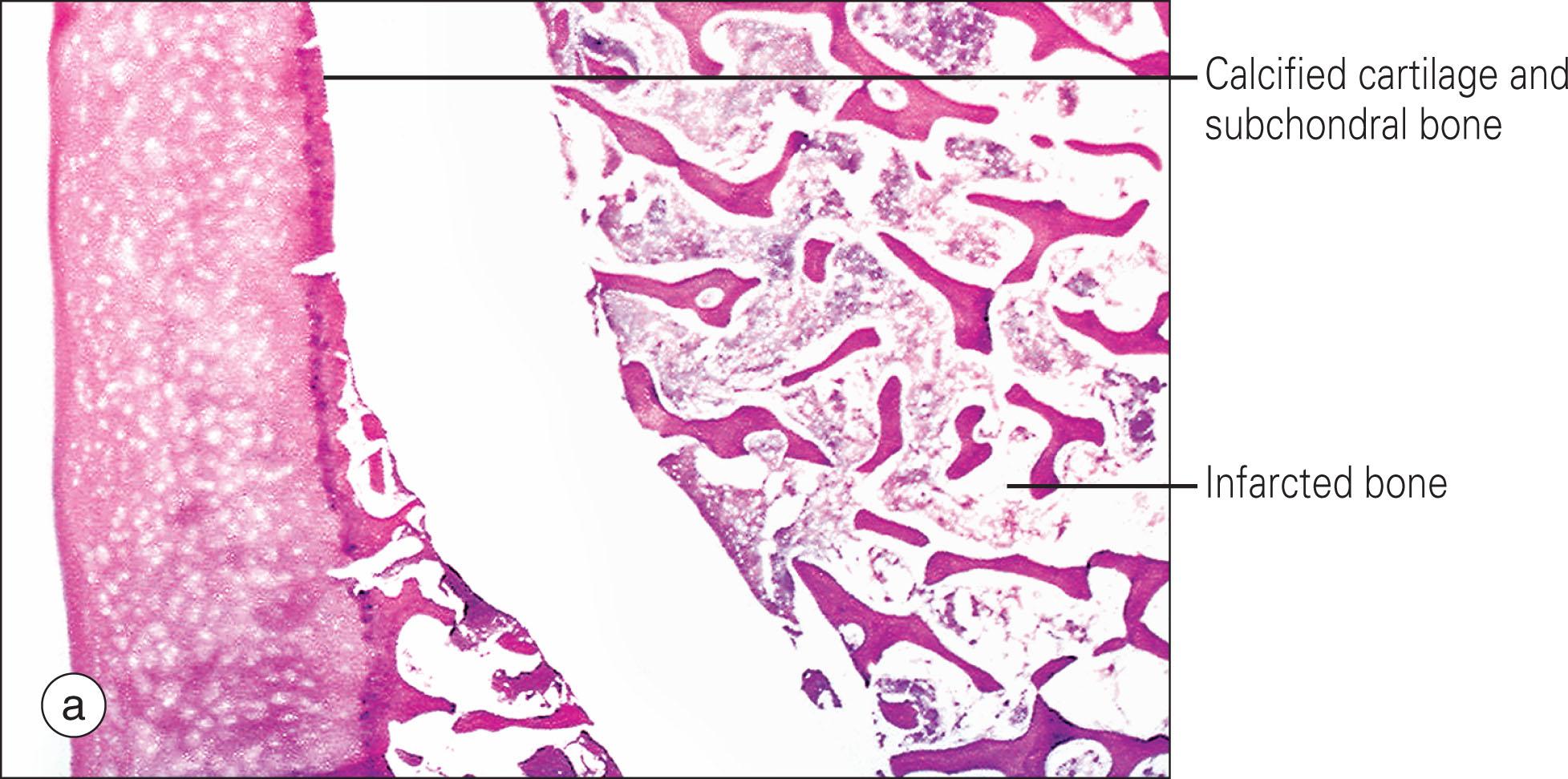 Fig. 208.2, Bone infarction (osteonecrosis). (a) Photomicrograph at the margin of the subchondral crescent. (b) The junction between the necrotic and viable bone; at the left of the picture, the thickened trabeculae of viable bone are evident. This thickening is the result of new bone deposition on the trabecular surfaces, which occurs as part of the healing of the infarct (and eosin stain; magnification ×4).