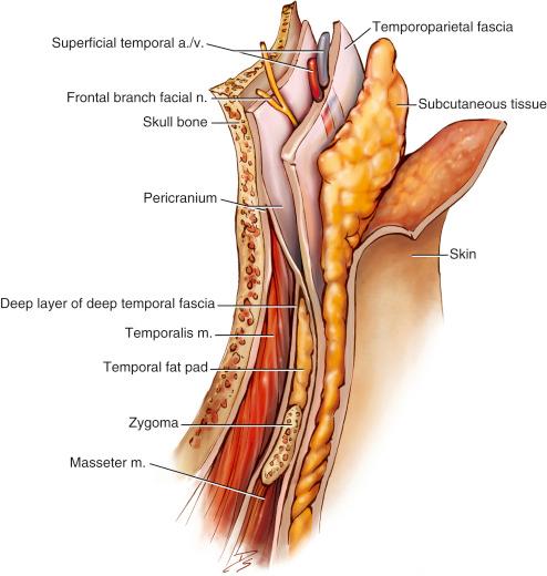 Fig. 33.1, Drawing detailing the layers of the scalp. The mnemonic SCALP refers to the various layers. It is important to know where the branches of the facial nerve and vascular structures are located before the coronal flap is elevated. The frontal branch of the facial nerve traverses deep to the temporoparietal fascia but superficial to the pericranium and the superficial layer of the deep temporal fascia. a., Artery; CN, cranial nerve; m., muscle; v., vein.