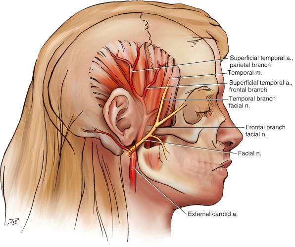 Fig. 33.2, Drawing showing the temporoparietal fascia, the most superficial fascial layer and an important anatomic landmark. The superficial temporal vessel runs along the outer aspect of it and travels vertically in the preauricular space as a terminal branch of the external carotid artery. The frontal branch of the facial nerve runs on its deep surface and travels superior to the supraorbital bony rim. a., Artery; m., muscle; n., nerve.