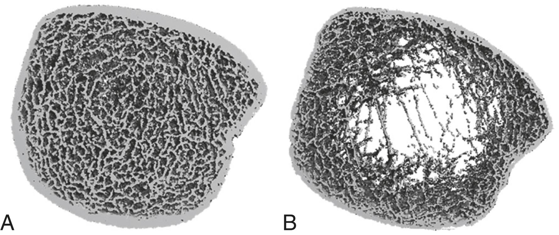 FIGURE 225-2, High-resolution peripheral computed tomography (Xtreme CT) of distal tibia in subject with normal bone mineral density ( A ) and severe osteoporosis ( B ).