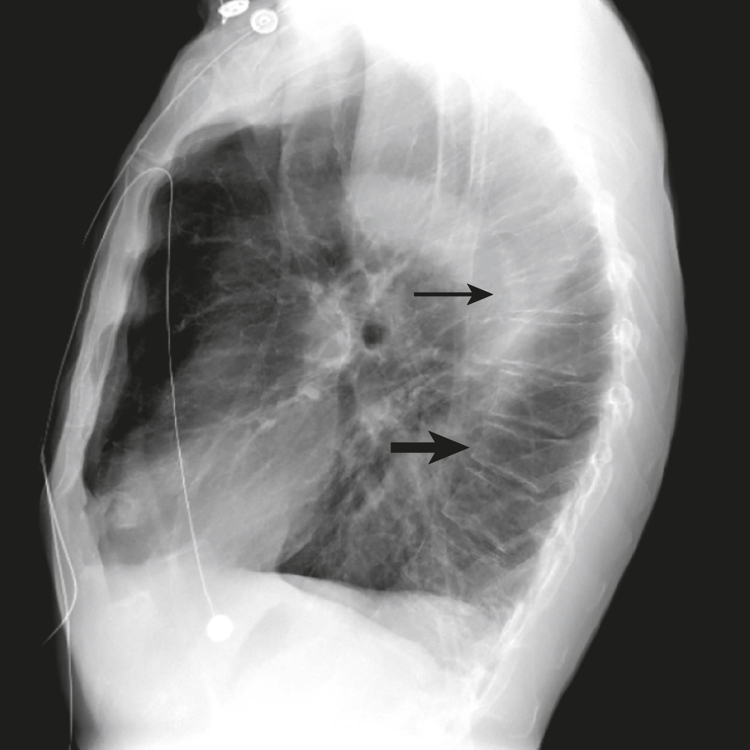 FIGURE 225-3, Incidental vertebral compression fractures on chest radiograph.