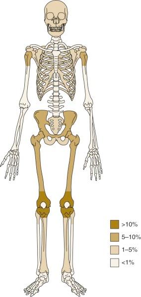 Figure 62-3, Anatomic sites of osteosarcoma at initial presentation.