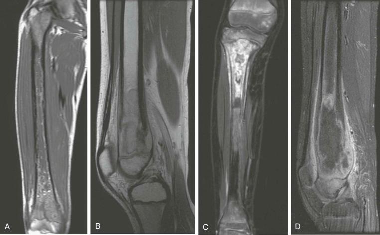 Figure 62-4, MRI appearance of osteosarcoma and lesions that can be confused with osteosarcoma in clinical presentation and radiographic appearance.