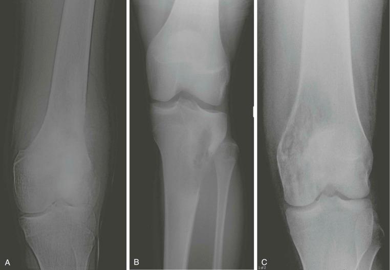 Figure 62-5, Three typical patterns observed in plain radiographs of osteosarcoma.