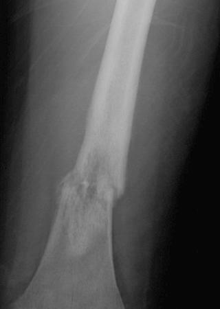 Figure 62-6, Pathologic fracture in an osteosarcoma of the distal femur.