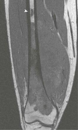 Figure 62-7, Skip metastasis (arrowhead) of an osteosarcoma of the distal femur as seen on T1-weighted MR image.