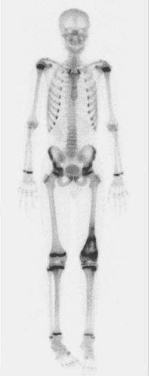 Figure 62-8, Technetium-99 m bone scan showing an osteosarcoma of the distal femur without distant bony metastases.