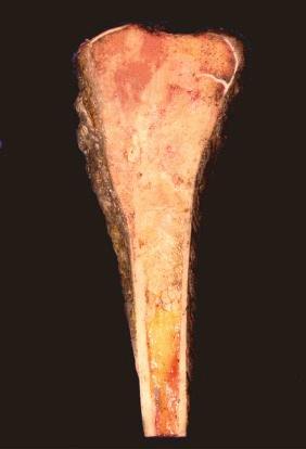 Figure 62-9, Osteosarcoma: gross pathologic appearance.