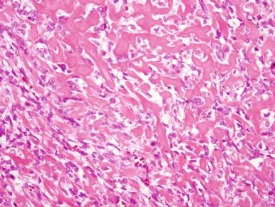 Figure 62-10, High-grade osteosarcoma composed of malignant-appearing tumor cells having a high nuclear-to-cytoplasmic ratio, hyperchromatism, and prominent nucleoli and an abundant eosinophilic osteoid matrix.