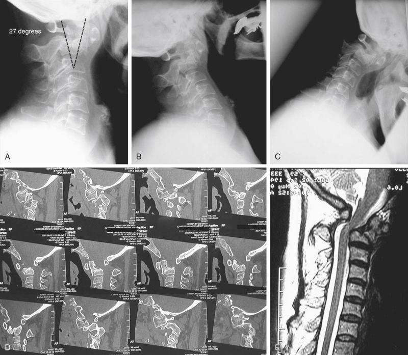 FIGURE 37-2, A 59-year-old woman with a history of rheumatoid arthritis and severe suboccipital neck pain and early signs of myelopathy 6 months after a motor vehicle accident resulting in a type III odontoid fracture that was managed conservatively in a SOMI brace. Plain radiograph, computed tomography, and magnetic resonance imaging show development of fixed 27 degree kyphotic deformity ( A to C ), bilateral facet joint dislocations ( D ), and spinal cord compression ( E ).