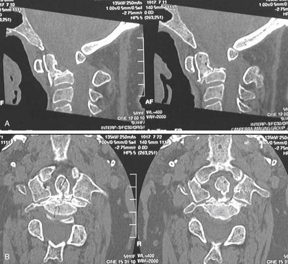 FIGURE 37-3, Computed tomography sagittal and coronal reconstructions showing the orientation of the planned osteotomy ( A ) and the bilateral extent of the base of the osteotomy ( B ).