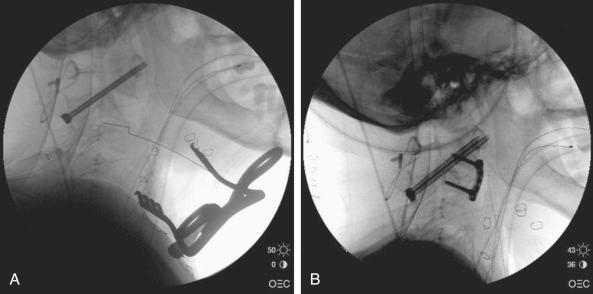 FIGURE 37-5, Intraoperative fluoroscopic images showing an anterior wedge defect resulting from posterior relocation of dislocated facet joints and transarticular screw fixation ( A ) and following anterior bone grafting and plate fixation ( B ).