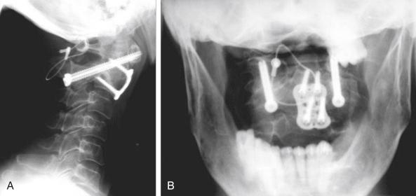 FIGURE 37-6, Six-month postoperative lateral ( A ) and anteroposterior ( B ) plain radiographs.