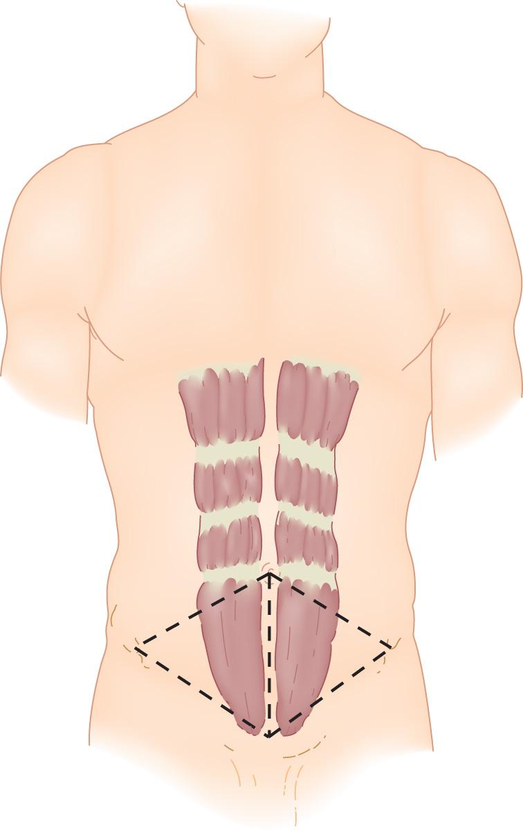 FIGURE 178.1, The ostomy triangle is defined by the anterior superior iliac spine, the umbilicus, and the pubic tubercle on the right and left sides of the abdominal wall for ileostomy and colostomy placement, respectively.
