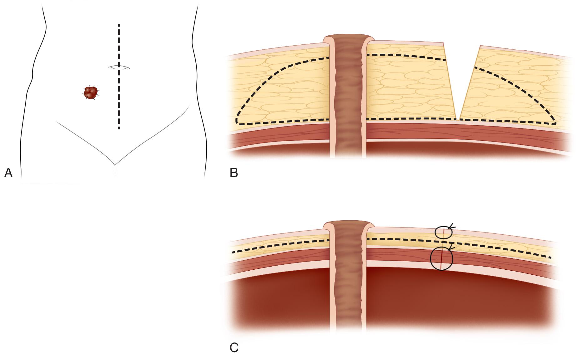 FIGURE 178.12, Medial approach. (A) Frontal view with skin incisions marked. (B) Cross section demonstrating midline incision and areas of subcutaneous fat excision. (C) After removal of excess subcutaneous tissue, incision is closed, flaps attached to fascia, and stoma matured with adequate eversion.