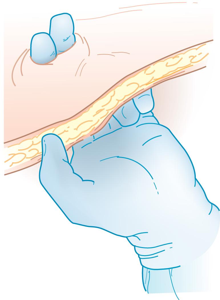 FIGURE 178.4, The stoma site admits two fingers.